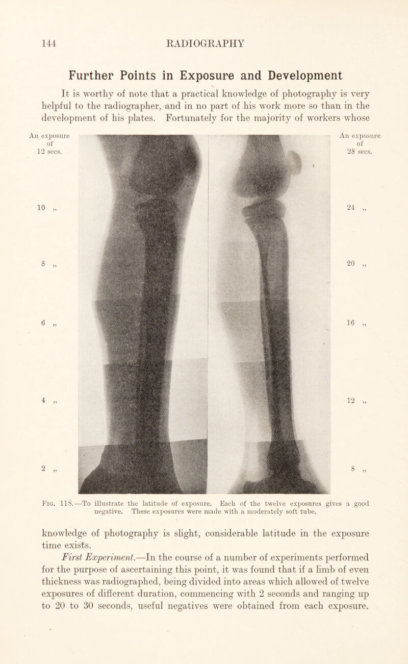 Further Points in Exposure and Development It is worthy of note that a practical knowledge of photography is very helpful to the radiographer, and in no part of his work more so than in the development of his plates. Fortunately for the majority of workers whose Fig. 118.—To illustrate the latitude of exposure. Each of the twelve exposures gives a good negative. These exposures were made with a moderately soft tube. knowledge of photography is slight, considerable latitude in the exposure time exists. First Experiment.—In the course of a number of experiments performed for the purpose of ascertaining this point, it was found that if a limb of even thickness was radiographed, being divided into areas which allowed of twelve exposures of different duration, commencing with 2 seconds and ranging up to 20 to 30 seconds, useful negatives were obtained from each exposure.