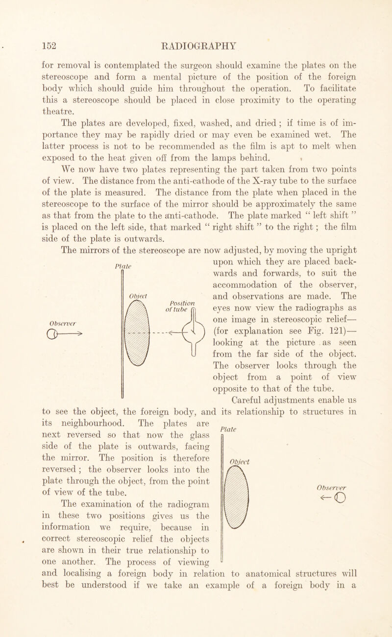 PI ale Object Position for removal is contemplated the surgeon should examine the plates on the stereoscope and form a mental picture of the position of the foreign body which should guide him throughout the operation. To facilitate this a stereoscope should be placed in close proximity to the operating theatre. The plates are developed, fixed, washed, and dried ; if time is of im¬ portance they may be rapidly dried or may even be examined wet. The latter process is not to be recommended as the film is apt to melt when exposed to the heat given off from the lamps behind. » We now have two plates representing the part taken from two points of view. The distance from the anti-cathode of the X-ray tube to the surface of the plate is measured. The distance from the plate when placed in the stereoscope to the surface of the mirror should be approximately the same as that from the plate to the anti-cathode. The plate marked “ left shift ” is placed on the left side, that marked “ right shift55 to the right; the film side of the plate is outwards. The mirrors of the stereoscope are now adjusted, by moving the upright upon which they are placed back¬ wards and forwards, to suit the accommodation of the observer, and observations are made. The eyes now view the radiographs as one image in stereoscopic relief— (for explanation see Fig. 121)— looking at the picture as seen from the far side of the object. The observer looks through the object from a point of view opposite to that of the tube. Careful adjustments enable us to see the object, the foreign body, and its relationship to structures in its neighbourhood. The plates are next reversed so that now the glass side of the plate is outwards, facing the mirror. The position is therefore reversed; the observer looks into the plate through the object, from the point of view of the tube. The examination of the radiogram in these two positions gives us the information we require, because in correct stereoscopic relief the objects are shown in their true relationship to one another. The process of viewing and localising a foreign body in relation to anatomical structures will best be understood if we take an example of a foreign body in a Observer G>—- Plate Object Observer <-o