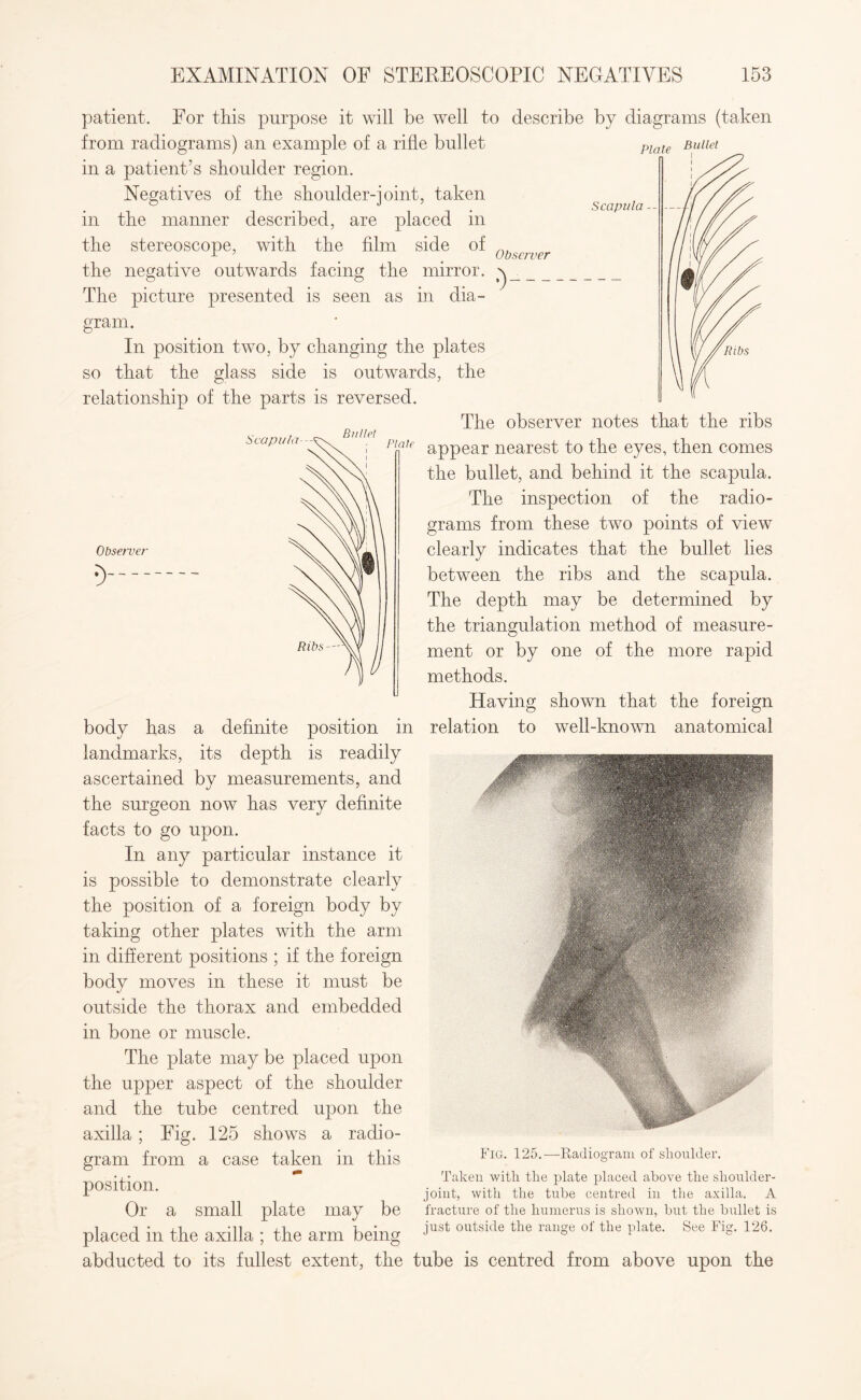Plate Bullet patient. For this purpose it will be well to describe by diagrams (taken from radiograms) an example of a rifle bullet in a patient’s shoulder region. Negatives of the shoulder-joint, taken in the manner described, are placed in the stereoscope, with the film side of the negative outwards facing the mirror. The picture presented is seen as in dia- Scapula Observer gram. In position two, by changing the plates so that the glass side is outwards, the relationship of the parts is reversed. body has a definite position in landmarks, its depth is readily ascertained by measurements, and the surgeon now has very definite facts to go upon. In any particular instance it is possible to demonstrate clearly the position of a foreign body by taking other plates with the arm in different positions ; if the foreign body moves in these it must be outside the thorax and embedded in bone or muscle. The plate may be placed upon the upper aspect of the shoulder and the tube centred upon the axilla ; Fig. 125 shows a radio¬ gram from a case taken in this position. Or a small plate may be placed in the axilla ; the arm being abducted to its fullest extent, the The observer notes that the ribs appear nearest to the eyes, then comes the bullet, and behind it the scapula. The inspection of the radio¬ grams from these two points of view clearly indicates that the bullet lies between the ribs and the scapula. The depth may be determined by the triangulation method of measure¬ ment or by one of the more rapid methods. Having shown that the foreign relation to well-known anatomical Fig. 125.—Radiogram of slioulder. Taken with the plate placed above the shoulder- joint, with the tube centred in the axilla. A fracture of the humerus is shown, but the bullet is just outside the range of the plate. See Fig. 126. tube is centred from above upon the