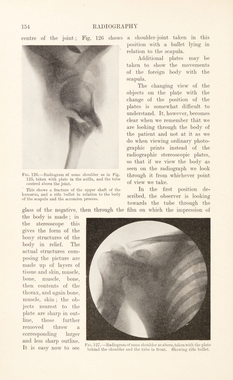 centre of the joint; Fig. 126 shows a shoulder-joint taken in this position with a bullet lying in relation to the scapula. Additional plates may be taken to show the movements of the foreign body with the scapula. The changing view of the objects on the plafe with the change of the position of the plates is somewhat difficult to understand. It, however, becomes clear when we remember that we are looking through the body of the patient and not at it as we do when viewing ordinary photo¬ graphic prints instead of the radiographic stereoscopic plates, so that if we view the body as seen on the radiograph we look through it from whichever point of view we take. In the first position de¬ scribed, the observer is looking towards the tube through the glass of the negative, then through the film on which the impression of the body is made ; in the stereoscope this gives the form of the bony structures of the body in relief. The actual structures com¬ posing the picture are made up of layers of tissue and skin, muscle, bone, muscle, bone, then contents of the thorax, and again bone, muscle, skin ; the ob¬ jects nearest to the plate are sharp in out¬ line, those further removed throw a corresponding larger and less sharp outline. y, . Fig. 127.—Radiogram of same shoulder as above, taken with the plate It IS easy now to see behind the shoulder and the tube in front. Showing rifle bullet. Fig. 126.—Radiogram of same shoulder as in Fig. 125, taken with plate in the axilla, and the tub( centred above the joint. This shows a fracture of the upper shaft of tin humerus, and a rifle bullet in relation to the bod} of the scapula and the acromion process.