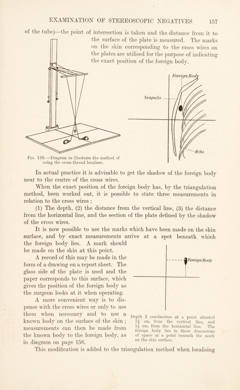 of the tube)—the point of intersection is taken and the distance from it to the surface of the plate is measured. The marks on the skin corresponding to the cross wires on the plates are utilised for the purpose of indicating the exact position of the foreign body. Foreign Bodi Fig. 130.—Diagram to illustrate the method of using the cross-thread localiser. In actual practice it is advisable to get the shadow of the foreign body near to the centre of the cross wires. When the exact position of the foreign body has, by the triangulation method, been worked out, it is possible to state three measurements in relation to the cross wires : (1) The depth, (2) the distance from the vertical line, (3) the distance from the horizontal line, and the section of the plate defined by the shadow of the cross wires. It is now possible to use the marks which have been made on the skin surface, and by exact measurements arrive at a spot beneath which the foreign body lies. A mark should be made on the skin at this point. A record of this may be made in the form of a drawing on a report sheet. The glass side of the plate is used and the paper corresponds to this surface, which gives the position of the foreign body as the surgeon looks at it when operating. A more convenient way is to dis¬ pense with the cross wires or only to use them when necessary and to use a known body on the surface of the skin ; measurements can then be made from the known body to the foreign body, as in diagram on page 158. This modification is added to the triangulation method when localising Depth 3 centimetres at a point situated If cm. from the vertical line, and 1| cm. from the horizontal line. The foreign body lies in these dimensions of space at a point beneath the mark on the skin surface.