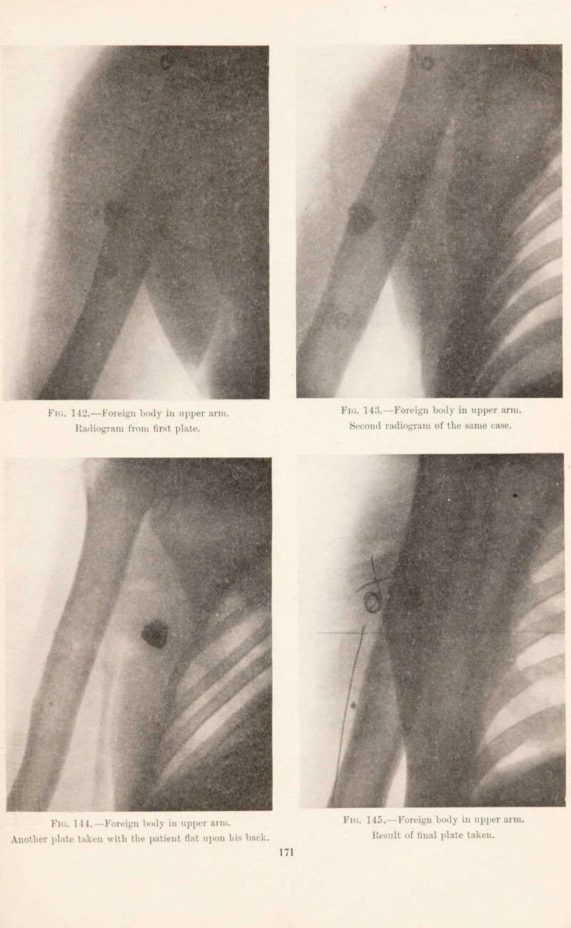 Fig. 142.—Foreign body in upper arm. Radiogram from first plate. Fig. 143.—Foreign body in upper arm. Second radiogram of the same case. Fig. 144.—Foreign body in upper arm. Another plate taken with the patient flat upon his back. Fig. 145.—Foreign body in upper arm. Result of final plate taken.