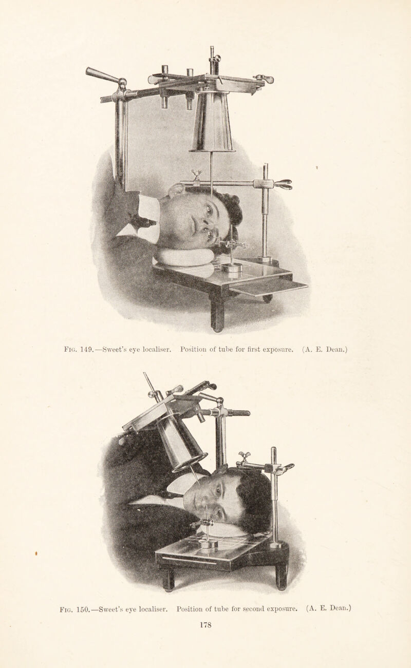 Fig. 150.—Sweet’s eye localiser. Position of tube for second exposure. (A. E. Dean.)