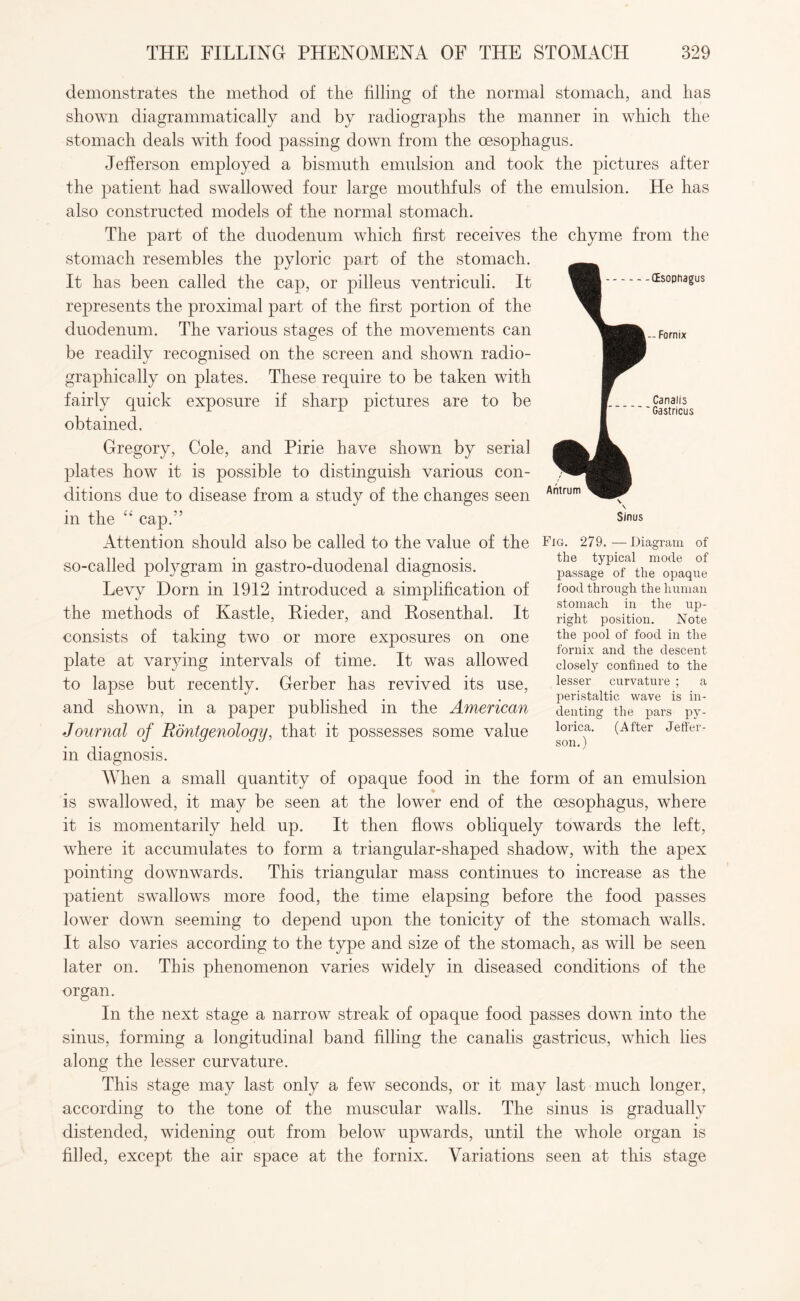 demonstrates the method of the filling of the normal stomach, and has shown diagrammatically and by radiographs the manner in which the stomach deals with food passing down from the oesophagus. Jefferson employed a bismuth emulsion and took the pictures after the patient had swallowed four large mouthfuls of the emulsion. He has also constructed models of the normal stomach. The part of the duodenum which first receives the chyme from the stomach resembles the pyloric part of the stomach. It has been called the cap, or pilleus ventriculi. It represents the proximal part of the first portion of the duodenum. The various stages of the movements can be readily recognised on the screen and shown radio¬ graphically on plates. These require to be taken with fairly quick exposure if sharp pictures are to be obtained. Gregory, Cole, and Pirie have shown by serial plates how it is possible to distinguish various con¬ ditions due to disease from a study of the changes seen in the “ cap.” Attention should also be called to the value of the so-called polygram in gastro-duodenal diagnosis. Levy Dorn in 1912 introduced a simplification of the methods of Kastle, Rieder, and Rosenthal. It consists of taking two or more exposures on one plate at varying intervals of time. It was allowed to lapse but recently. Gerber has revived its use, and shown, in a paper published in the American Journal of Rontgenology, that it possesses some value in diagnosis. When a small quantity of opaque food in the form of an emulsion is swallowed, it may be seen at the lower end of the oesophagus, where it is momentarily held up. It then flows obliquely towards the left, where it accumulates to form a triangular-shaped shadow, with the apex pointing downwards. This triangular mass continues to increase as the patient swallows more food, the time elapsing before the food passes lower down seeming to depend upon the tonicity of the stomach walls. It also varies according to the type and size of the stomach, as will be seen later on. This phenomenon varies widely in diseased conditions of the organ. In the next stage a narrow streak of opaque food passes down into the sinus, forming a longitudinal band filling the canalis gastricus, which lies along the lesser curvature. This stage may last only a few seconds, or it may last much longer, according to the tone of the muscular walls. The sinus is gradually distended, widening out from below upwards, until the whole organ is filled, except the air space at the fornix. Variations seen at this stage (Esophagus — Fornix Canalis Gastricus Sinus Fig. 279.—Diagram of the typical mode of passage of the opaque food through the human stomach in the up¬ right position. Note the pool of food in the fornix and the descent closely confined to the lesser curvature ; a peristaltic wave is in¬ denting the pars py- lorica. (After Jeffer¬ son.)