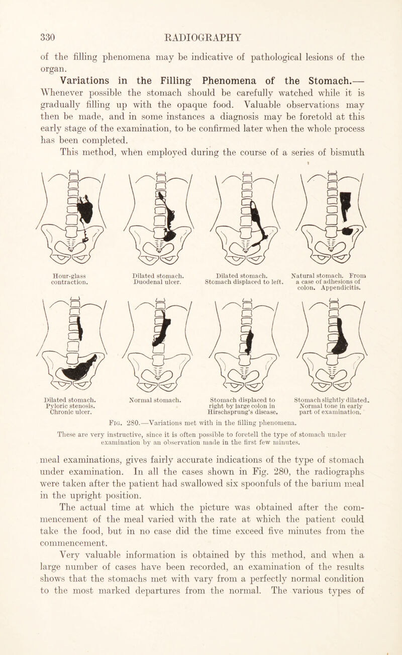 of the filling phenomena may be indicative of pathological lesions of the organ. Variations in the Filling’ Phenomena of the Stomach.— Whenever possible the stomach should be carefully watched while it is gradually filling up with the opaque food. Valuable observations may then be made, and in some instances a diagnosis may be foretold at this early stage of the examination, to be confirmed later when the whole process has been completed. This method, when employed during the course of a series of bismuth Hour-glass contraction. Dilated stomach. Pyloric stenosis. Chronic ulcer. Fig. Dilated stomach Duodenal ulcer. Normal stomach. Dilated stomach. Stomach displaced to left. Stomach displaced to right by large colon in Hirschsprung’s disease. Natural stomach. From a case of adhesions of colon. Appendicitis. Stomach slightly dilated. Normal tone in early part of examination. 280.—Variations met with in tlie tilling phenomena. These are very instructive, since it is often possible to foretell the type of stomach under examination by an observation made in the first few minutes. meal examinations, gives fairly accurate indications of the type of stomach under examination. In all the cases shown in Fig. 280, the radiographs were taken after the patient had swallowed six spoonfuls of the barium meal in the upright position. The actual time at which the picture was obtained after the com¬ mencement of the meal varied with the rate at which the patient could take the food, but in no case did the time exceed five minutes from the commencement. Very valuable information is obtained by this method, and when a large number of cases have been recorded, an examination of the results shows that the stomachs met with vary from a perfectly normal condition to the most marked departures from the normal. The various types of