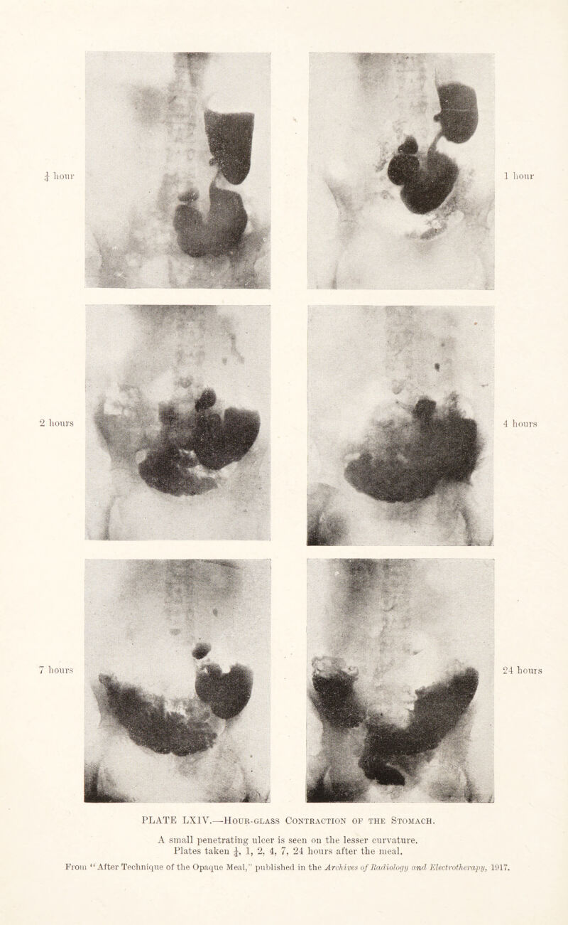\ hour 1 hour 2 hours 4 hours 7 hours 24 hours PLATE LXIV.—Hour-glass Contraction of the Stomach. A small penetrating ulcer is seen on the lesser curvature. Plates taken 1, 2, 4, 7, 24 hours after the meal.