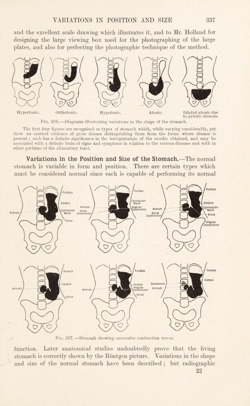 and the excellent scale drawing which illustrates it, and to Mr. Holland for designing the large viewing box used for the photographing of the large plates, and also for perfecting the photographic technique of the method. Hypertonic. Orthotonic. Hypotonic. Atonic. Dilated atonic due to pyloric stenosis. Fig. 286.—Diagrams illustrating variations in the shape of the stomach. The first four figures are recognised as types of stomach which, while varying considerably, yet show no marked evidence of gross disease distinguishing them from the forms where disease is present; each has a definite significance in the interpretation of the results obtained, and may be associated with a definite train of signs and symptoms in relation to the various diseases met with in other portions of the alimentary tract. Variations in the Position and Size of the Stomach.—The normal stomach is variable in form and position. There are certain types which must be considered normal since each is capable of performing its normal Fig. 287.—Stomach showing successive contraction waves. function. Later anatomical studies undoubtedly prove that the living stomach is correctly shown by the Rontgen picture. Variations in the shape and size of the normal stomach have been described ; but radiographic 22
