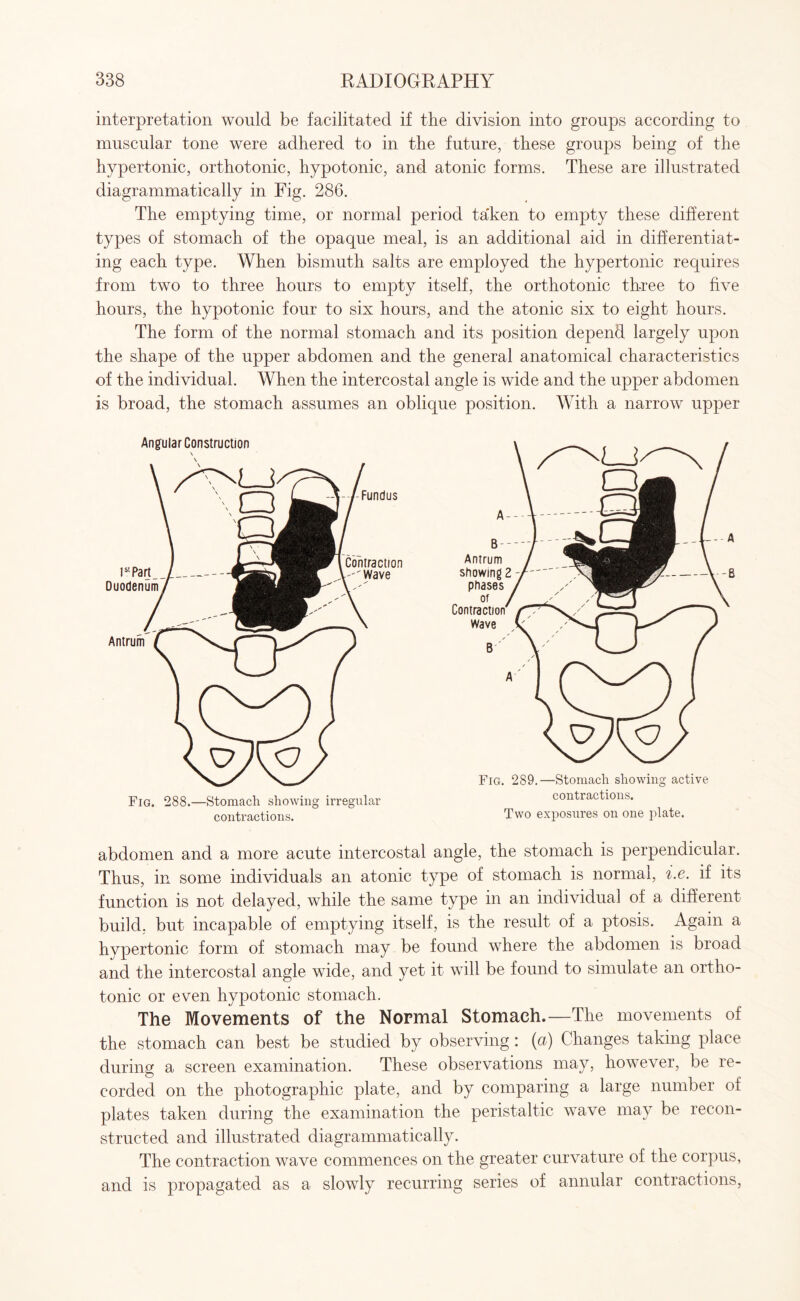 interpretation would be facilitated if the division into groups according to muscular tone were adhered to in the future, these groups being of the hypertonic, orthotonic, hypotonic, and atonic forms. These are illustrated diagrammatically in Fig. 286. The emptying time, or normal period ta'ken to empty these different types of stomach of the opaque meal, is an additional aid in differentiat¬ ing each type. When bismuth salts are employed the hypertonic requires from two to three hours to empty itself, the orthotonic three to five hours, the hypotonic four to six hours, and the atonic six to eight hours. The form of the normal stomach and its position depend largely upon the shape of the upper abdomen and the general anatomical characteristics of the individual. When the intercostal angle is wide and the upper abdomen is broad, the stomach assumes an oblique position. With a narrow upper Angular Construction l51 Part _ Duodenum Antrum Fundus Contraction 'Wave Fig. 288.—Stomach showing irregular contractions. B Antrum showing 2 -t phases of Contraction Wave Fig. 289.—Stomach showing active contractions. Two exposures on one plate. abdomen and a more acute intercostal angle, the stomach is perpendicular. Thus, in some individuals an atonic type of stomach is normal, i.e. if its function is not delayed, while the same type in an individual of a different build, but incapable of emptying itself, is the result of a ptosis. Again a hypertonic form of stomach may be found where the abdomen is broad and the intercostal angle wide, and yet it will be found to simulate an ortho- tonic or even hypotonic stomach. The Movements of the Normal Stomach.—The movements of the stomach can best be studied by observing: (a) Changes taking place during a screen examination. These observations may, however, be re¬ corded on the photographic plate, and by comparing a large number of plates taken during the examination the peristaltic wave may be recon¬ structed and illustrated diagrammatically. The contraction wave commences on the greater curvature of the corpus, and is propagated as a slowly recurring series of annular contractions,