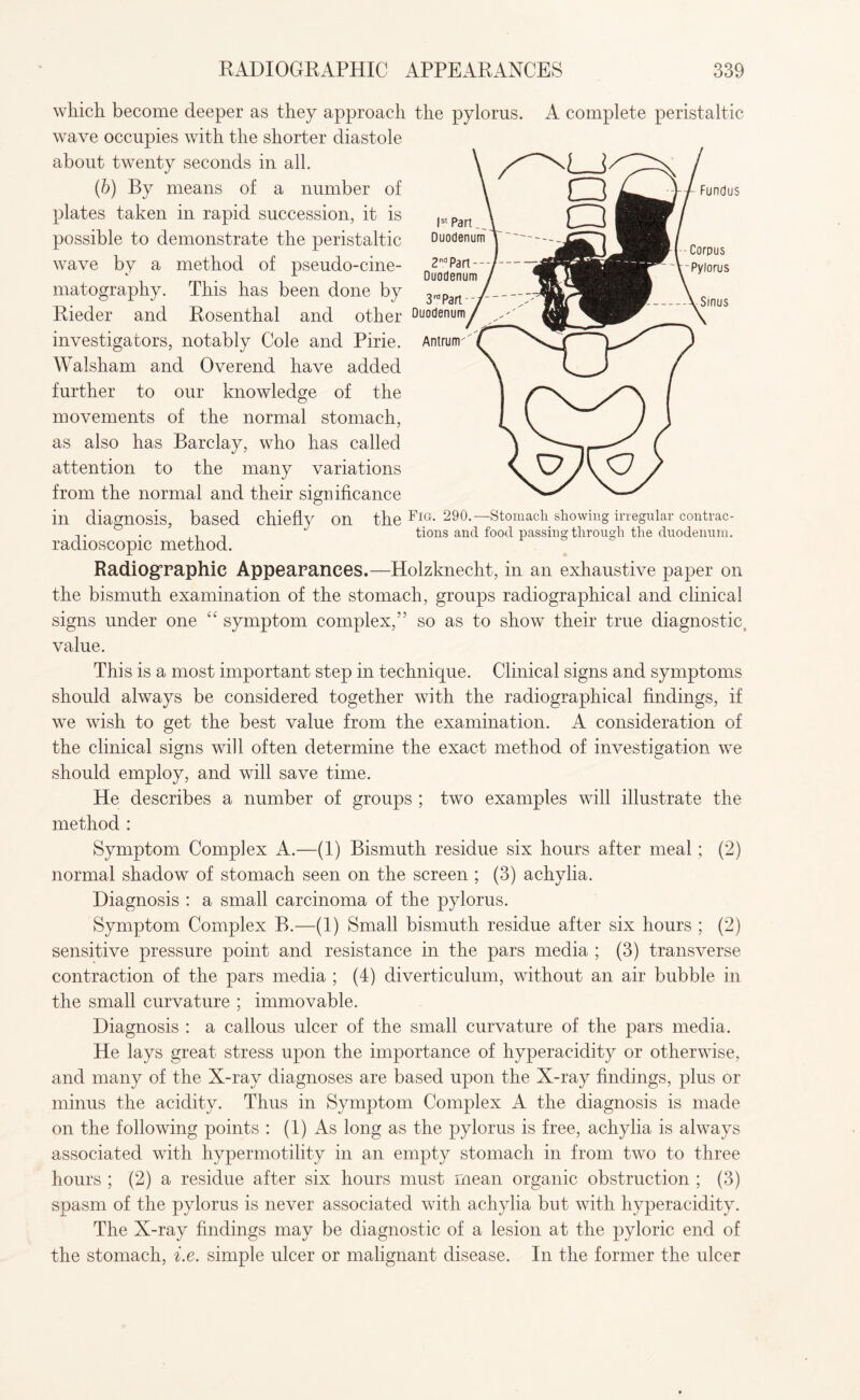 Is' Part., Duodenum 2nd Part - Duodenum 3 rd Part Fundus Corpus Pylorus Sinus which become deeper as they approach the pylorus. A complete peristaltic wave occupies with the shorter diastole about twenty seconds in all. (b) By means of a number of plates taken in rapid succession, it is possible to demonstrate the peristaltic wave by a method of pseudo-cine¬ matography. This has been done by Rieder and Rosenthal and other Duodenum; investigators, notably Cole and Pirie. Antrum' Walsham and Overend have added further to our knowledge of the movements of the normal stomach, as also has Barclay, who has called attention to the many variations from the normal and their significance in diagnosis, based chiefly on the FlG-290-—stomach showins irregular contrac- . . ,, , tions and food passing through the duodenum. radioscopic method. Radiographic Appearances.—Holzknecht, in an exhaustive paper on the bismuth examination of the stomach, groups radiographical and clinical signs under one “ symptom complex,” so as to show their true diagnostic value. This is a most important step in technique. Clinical signs and symptoms should always be considered together with the radiographical findings, if we wish to get the best value from the examination. A consideration of the clinical signs will often determine the exact method of investigation we should employ, and will save time. He describes a number of groups ; two examples will illustrate the method : Symptom Complex A.—(1) Bismuth residue six hours after meal; (2) normal shadow of stomach seen on the screen ; (3) achylia. Diagnosis : a small carcinoma of the pylorus. Symptom Complex B.—(1) Small bismuth residue after six hours ; (2) sensitive pressure point and resistance in the pars media ; (3) transverse contraction of the pars media ; (4) diverticulum, without an air bubble in the small curvature ; immovable. Diagnosis : a callous ulcer of the small curvature of the pars media. He lays great stress upon the importance of hyperacidity or otherwise, and many of the X-ray diagnoses are based upon the X-ray findings, plus or minus the acidity. Thus in Symptom Complex A the diagnosis is made on the following points : (1) As long as the pylorus is free, achylia is always associated with hypermotility in an empty stomach in from two to three hours ; (2) a residue after six hours must mean organic obstruction ; (3) spasm of the pylorus is never associated with achylia but with hyperacidity. The X-ray findings may be diagnostic of a lesion at the pyloric end of the stomach, i.e. simple ulcer or malignant disease. In the former the ulcer