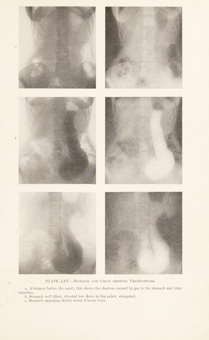 a, Abdomen before the meal; this shows the shadows caused by gas in the stomach and large intestine. b, Stomach well filled, situated low down in the pelvis, elongated.