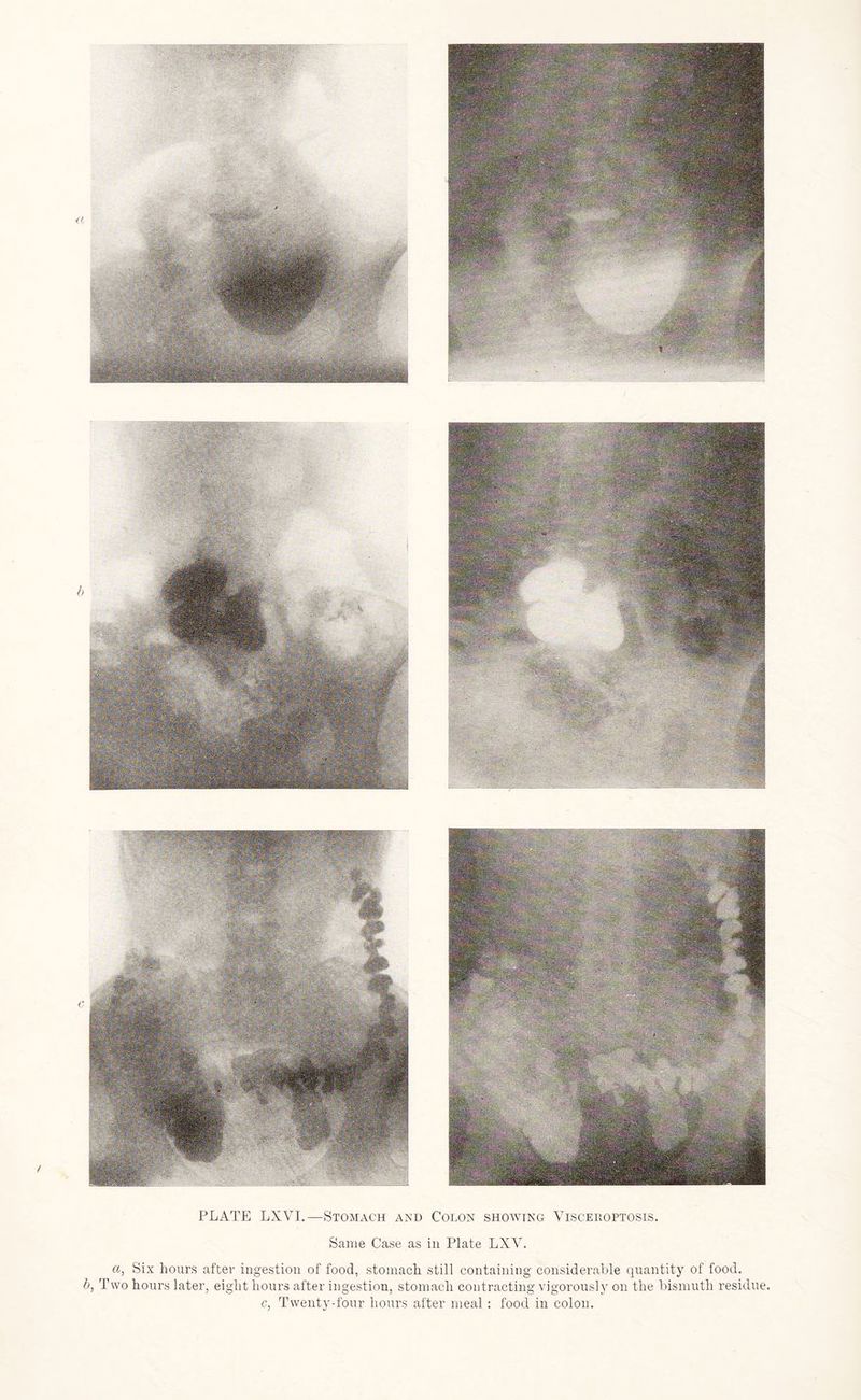 Same Case as in Plate LXV. a, Six hours after ingestion of food, stomach still containing considerable quantity of food. b, Two hours later, eight hours after ingestion, stomach contracting vigorously on the bismuth residue. c, Twenty-four hours after meal : food in colon.