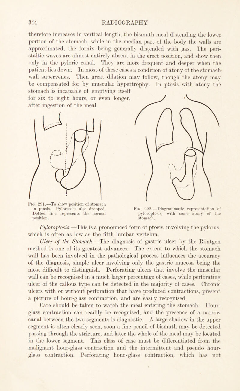 therefore increases in vertical length, the bismuth meal distending the lower portion of the stomach, while in the median part of the body the walls are approximated, the fornix being generally distended with gas. The peri¬ staltic waves are almost entirely absent in the erect position, and show then only in the pyloric canal. They are more frequent and deeper when the patient lies down. In most of these cases a condition of atony of the stomach wall supervenes. Then great dilation may follow, though the atony may be compensated for by muscular hypertrophy. In ptosis with atony the stomach is incapable of emptying itself for six to eight hours, or even longer, after ingestion of the meal. Fig. 291.—To show position of stomach in ptosis. Pylorus is also dropped. Dotted line represents the normal position. stomach. Pyloroptosis.—This is a pronounced form of ptosis, involving the pylorus, which is often as low as the fifth lumbar vertebra. Ulcer of the Stomach.—The diagnosis of gastric ulcer by the Rontgen method is one of its greatest advances. The extent to which the stomach wall has been involved in the pathological process influences the accuracy of the diagnosis, simple ulcer involving only the gastric mucosa being the most difficult to distinguish. Perforating ulcers that involve the muscular wall can be recognised in a much larger percentage of cases, while perforating ulcer of the callous type can be detected in the majority of cases. Chronic ulcers with or without perforation that have produced contractions, present a picture of hour-glass contraction, and are easily recognised. Care should be taken to watch the meal entering the stomach. Hour¬ glass contraction can readily be recognised, and the presence of a narrow canal between the two segments is diagnostic. A large shadow in the upper segment is often clearly seen, soon a fine pencil of bismuth may be detected passing through the stricture, and later the whole of the meal may be located in the lower segment. This class of case must be differentiated from the malignant hour-glass contraction and the intermittent and pseudo hour¬ glass contraction. Perforating hour-glass contraction, which has not