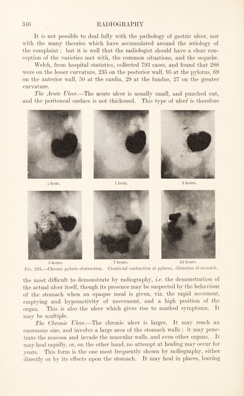 It is not possible to deal fully with the pathology of gastric ulcer, nor with the many theories which have accumulated around the aetiology of the complaint; but it is well that the radiologist should have a clear con¬ ception of the varieties met with, the common situations, and the sequelae. Welch, from hospital statistics, collected 793 cases, and found that 288 were on the lesser curvature, 235 on the posterior wall, 95 at the pylorus, 69 on the anterior wall, 50 at the cardia, 29 at the fundus, 27 on the greater curvature. The Acute Ulcer.—The acute ulcer is usually small, and punched out, and the peritoneal surface is not thickened. This type of ulcer is therefore l hour. 1 hour. 3 hours. 5 hours. Fig. 293.—Chronic pyloric obstruction. 7 hours. 24 hours. Cicatricial contraction at pylorus, dilatation of stomach. the most difficult to demonstrate by radiography, i.e. the demonstration of the actual ulcer itself, though its presence may be suspected by the behaviour of the stomach when an opaque meal is given, viz. the rapid movement, emptying and hyperactivity of movement, and a high position of the organ. This is also the ulcer which gives rise to marked symptoms. It may be multiple. The Chronic Ulcer.—The chronic ulcer is larger. It may reach an enormous size, and involve a large area of the stomach walls ; it may pene¬ trate the mucosa and invade the muscular walls, and even other organs. It may heal rapidly, or, on the other hand, no attempt at healing may occur for years. This form is the one most frequently shown by radiography, either directly or by its effects upon the stomach. It may heal in places, leaving