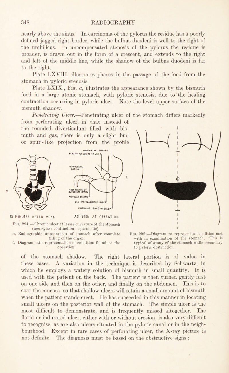 nearly above the sinus. In carcinoma of the pylorus the residue has a poorly defined jagged right border, while the bulbus duodeni is well to the right of the umbilicus. In uncompensated stenosis of the pylorus the residue is broader, is drawn out in the form of a crescent, and extends to the right and left of the middle line, while the shadow of the bulbus duodeni is far to the right. Plate LXVIII. illustrates phases in the passage of the food from the stomach in pyloric stenosis. Plate LXIX., Fig. a, illustrates the appearance shown by the bismuth food in a large atonic stomach, with pyloric stenosis, due to the healing contraction occurring in pyloric ulcer. Note the level upper surface of the bismuth shadow. Penetrating Ulcer.—Penetrating ulcer of the stomach differs markedly from perforating ulcer, in that instead of the rounded diverticulum filled with bis¬ muth and gas, there is only a slight bud or spur - like projection from the profile 15 MINUTES AFTER MEAL AS SEEN AT OPERATION % Fig. 294.—Chronic ulcer at lesser curvature of the stomach (hour-glass contraction—spasmodic). a, Radiographic appearances of stomach after complete tilling of the organ. b, Diagrammatic representation of condition found at the operation. Fig. 295.—Diagram to represent a condition met with in examination of the stomach. This is typical of atony of the stomach walls secondary to pyloric obstruction. of the stomach shadow. The right lateral portion is of value in these cases. A variation in the technique is described by Schwartz, in which he employs a watery solution of bismuth in small quantity. It is used with the patient on the back. The patient is then turned gently first on one side and then on the other, and finally on the abdomen. This is to coat the mucosa, so that shallow ulcers will retain a small amount of bismuth when the patient stands erect. He has succeeded in this manner in locating small ulcers on the posterior wall of the stomach. The simple ulcer is the most difficult to demonstrate, and is frequently missed altogether. The florid or indurated ulcer, either with or without erosion, is also very difficult to recognise, as are also ulcers situated in the pyloric canal or in the neigh¬ bourhood. Except in rare cases of perforating ulcer, the X-ray picture is not definite. The diagnosis must be based on the obstructive signs :