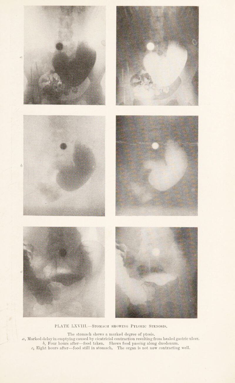 PLATE LXVIII.—Stomach showing Pyloric Stenosis. The stomach shows a marked degree of ptosis. a, Marked delay in emptying caused by cicatricial contraction resulting from healed gastric ulcer. b, Four hours after—food taken. Shows food passing along duodenum. c, Eight hours after—food still in stomach. The organ is not now contracting well.
