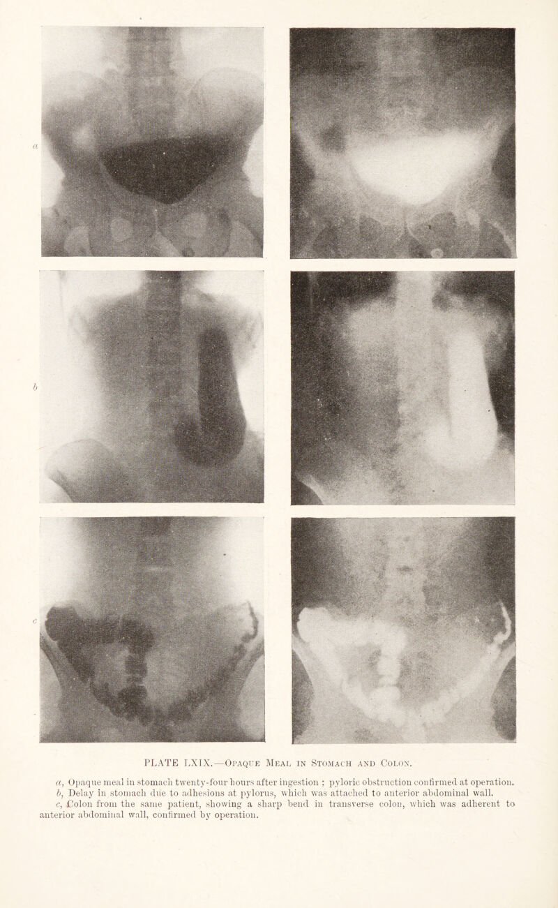 PLATE LXIX.—Opaque Meal in Stomach and Colon. a, Opaque meal in stomach twenty-four hours after ingestion ; pyloric obstruction confirmed at operation. b, Delay in stomach due to adhesions at pylorus, which was attached to anterior abdominal wall. c, Colon from the same patient, showing a sharp bend in transverse colon, which was adherent to anterior abdominal wall, confirmed by operation.
