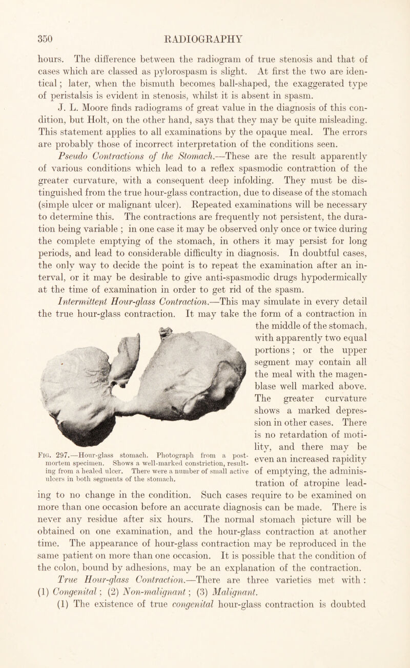 hours. The difference between the radiogram of true stenosis and that of cases which are classed as pylorospasm is slight. At first the two are iden¬ tical ; later, when the bismuth becomes ball-shaped, the exaggerated type of peristalsis is evident in stenosis, whilst it is absent in spasm. J. L. Moore finds radiograms of great value in the diagnosis of this con¬ dition, but Holt, on the other hand, says that they may be quite misleading. This statement applies to all examinations by the opaque meal. The errors are probably those of incorrect interpretation of the conditions seen. Pseudo Contractions of the Stomach.—These are the result apparently of various conditions which lead to a reflex spasmodic contraction of the greater curvature, with a consequent deep infolding. They must be dis¬ tinguished from the true hour-glass contraction, due to disease of the stomach (simple ulcer or malignant ulcer). Repeated examinations will be necessary to determine this. The contractions are frequently not persistent, the dura¬ tion being variable ; in one case it may be observed only once or twice during the complete emptying of the stomach, in others it may persist for long periods, and lead to considerable difficulty in diagnosis. In doubtful cases, the only way to decide the point is to repeat the examination after an in¬ terval, or it may be desirable to give anti-spasmodic drugs hypodermically at the time of examination in order to get rid of the spasm. Intermittent Hour-glass Contraction.—This may simulate in every detail the true hour-glass contraction. It may take the form of a contraction in the middle of the stomach, with apparently two equal portions; or the upper segment may contain all the meal with the magen- blase well marked above. The greater curvature shows a marked depres¬ sion in other cases. There is no retardation of moti¬ lity, and there may be even an increased rapidity of emptying, the adminis¬ tration of atropine lead¬ ing to no change in the condition. Such cases require to be examined on more than one occasion before an accurate diagnosis can be made. There is never any residue after six hours. The normal stomach picture will be obtained on one examination, and the hour-glass contraction at another time. The appearance of hour-glass contraction may be reproduced in the same patient on more than one occasion. It is possible that the condition of the colon, bound by adhesions, may be an explanation of the contraction. True Hour-glass Contraction.—There are three varieties met with : (1) Congenital; (2) Non-malignant; (3) Malignant. (1) The existence of true congenital hour-glass contraction is doubted Fig. 297 mortem specimen. Hour-glass ing from a healed ulcer ulcers in both segments of the stomach. stomach. Photograph from a post- Shows a well-marked constriction, result- There were a number of small active