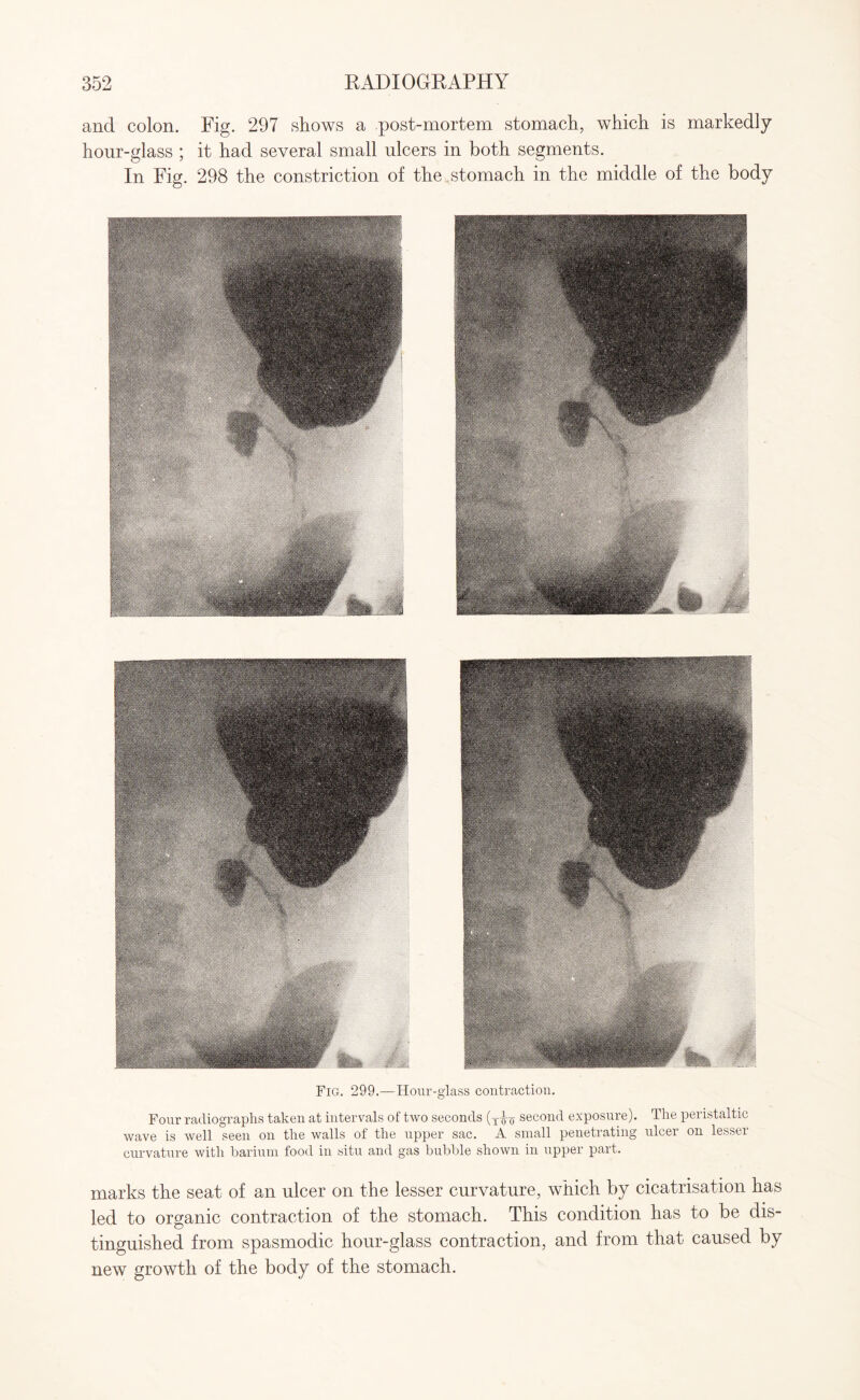 and colon. Fig. 297 shows a post-mortem stomach, which is markedly hour-glass ; it had several small ulcers in both segments. In Fig. 298 the constriction of the stomach in the middle of the body Fig. 299.—Hour-glass contraction. Four radiographs taken at intervals of two seconds (t^-q second exposure). The peristaltic wave is well seen on the walls of the upper sac. A small penetrating ulcer on lesser curvature with barium food in situ and gas bubble shown in upper part. marks the seat of an ulcer on the lesser curvature, which by cicatrisation has led to organic contraction of the stomach. This condition has to be dis¬ tinguished from spasmodic hour-glass contraction, and from that caused by new growth of the body of the stomach.