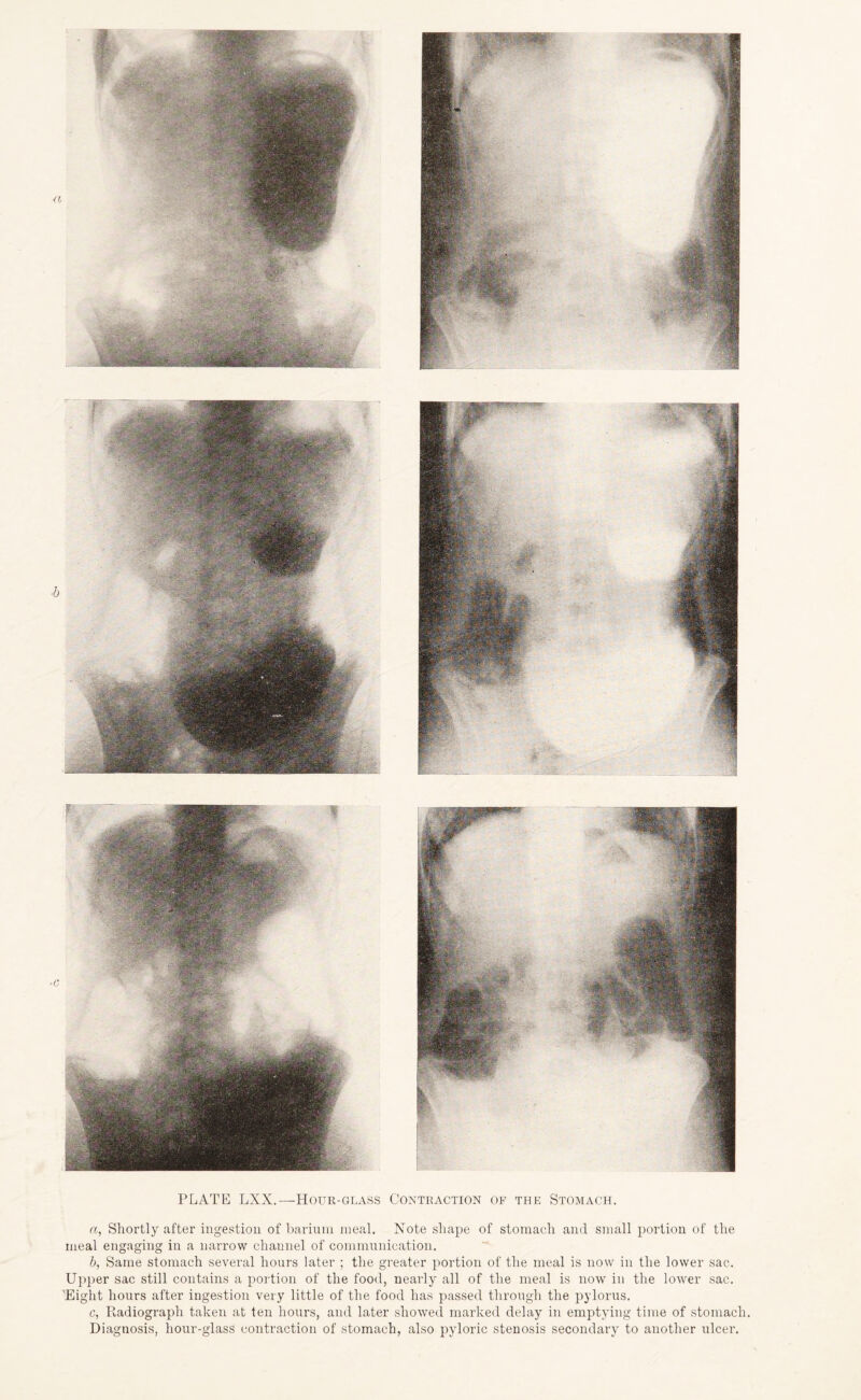 PLATE LXX.— Hour-glass Contraction of the Stomach. a, Shortly after ingestion of barium meal. Note shape of stomach and small portion of the meal engaging in a narrow channel of communication. b, Same stomach several hours later ; the greater portion of the meal is now in the lower sac. Upper sac still contains a portion of the food, nearly all of the meal is now in the lower sac. 'Eight hours after ingestion very little of the food has passed through the pylorus. c, Radiograph taken at ten hours, and later showed marked delay in emptying time of stomach. Diagnosis, hour-glass contraction of stomach, also pyloric stenosis secondary to another ulcer.