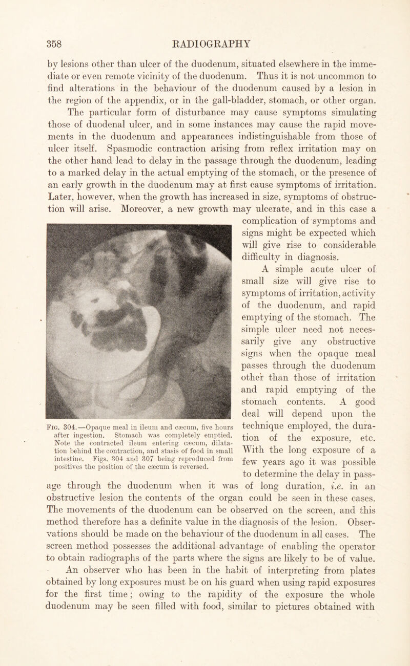 by lesions other than ulcer of the duodenum, situated elsewhere in the imme¬ diate or even remote vicinity of the duodenum. Thus it is not uncommon to find alterations in the behaviour of the duodenum caused by a lesion in the region of the appendix, or in the gall-bladder, stomach, or other organ. The particular form of disturbance may cause symptoms simulating those of duodenal ulcer, and in some instances may cause the rapid move¬ ments in the duodenum and appearances indistinguishable from those of ulcer itself. Spasmodic contraction arising from reflex irritation may on the other hand lead to delay in the passage through the duodenum, leading to a marked delay in the actual emptying of the stomach, or the presence of an early growth in the duodenum may at first cause symptoms of irritation. Later, however, when the growth has increased in size, symptoms of obstruc¬ tion will arise. Moreover, a new growth, may ulcerate, and in this case a complication of symptoms and signs might be expected which will give rise to considerable difficulty in diagnosis. A simple acute ulcer of small size will give rise to symptoms of irritation, activity of the duodenum, and rapid emptying of the stomach. The simple ulcer need not neces¬ sarily give any obstructive signs when the opaque meal passes through the duodenum other than those of irritation and rapid emptying of the stomach contents. A good deal will depend upon the technique employed, the dura¬ tion of the exposure, etc. With the long exposure of a few years ago it was possible to determine the delay in pass¬ age through the duodenum when it was of long duration, i.e. in an obstructive lesion the contents of the organ could be seen in these cases. The movements of the duodenum can be observed on the screen, and this method therefore has a definite value in the diagnosis of the lesion. Obser¬ vations should be made on the behaviour of the duodenum in all cases. The screen method possesses the additional advantage of enabling the operator to obtain radiographs of the parts where the signs are likely to be of value. An observer who has been in the habit of interpreting from plates obtained by long exposures must be on his guard when using rapid exposures for the first time; owing to the rapidity of the exposure the whole duodenum may be seen filled with food, similar to pictures obtained with Fig. 304.—Opaque meal in ileum and caecum, five hours after ingestion. Stomach was completely emptied. Note the contracted ileum entering caecum, dilata¬ tion behind the contraction, and stasis of food in small intestine. Figs. 304 and 307 being reproduced from positives the position of the caecum is reversed.