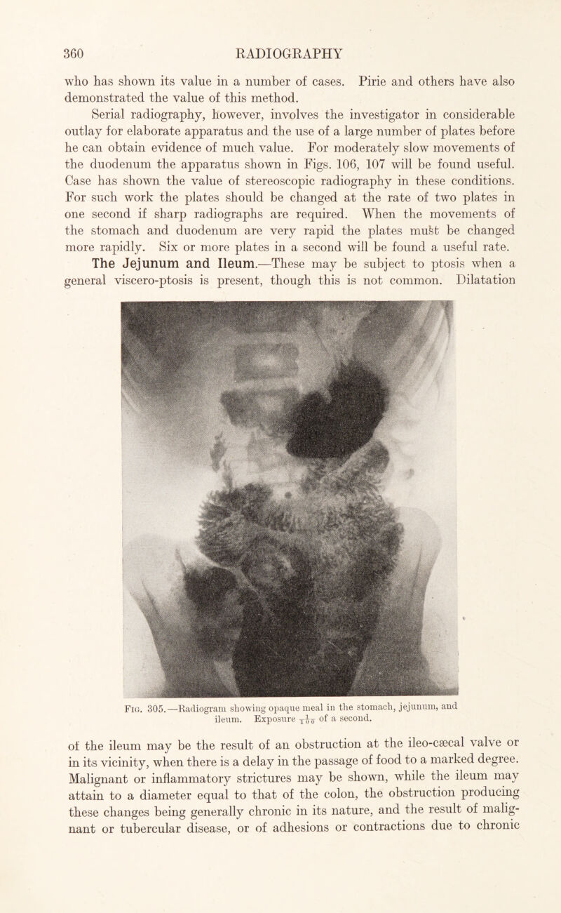 who has shown its value in a number of cases. Pirie and others have also demonstrated the value of this method. Serial radiography, however, involves the investigator in considerable outlay for elaborate apparatus and the use of a large number of plates before he can obtain evidence of much value. For moderately slow movements of the duodenum the apparatus shown in Figs. 106, 107 will be found useful. Case has shown the value of stereoscopic radiography in these conditions. For such work the plates should be changed at the rate of two plates in one second if sharp radiographs are required. When the movements of the stomach and duodenum are very rapid the plates mufet be changed more rapidly. Six or more plates in a second will be found a useful rate. The Jejunum and Ileum.—These may be subject to ptosis when a general viscero-ptosis is present, though this is not common. Dilatation Fig. 305.—Radiogram showing opaque meal in the stomach, jejunum, and ileum. Exposure XXq of a second. of the ileum may be the result of an obstruction at the ileo-csecal valve or in its vicinity, when there is a delay in the passage of food to a marked degree. Malignant or inflammatory strictures may be shown, while the ileum may attain to a diameter equal to that of the colon, the obstruction producing these changes being generally chronic in its nature, and the result of malig¬ nant or tubercular disease, or of adhesions or contractions due to chronic
