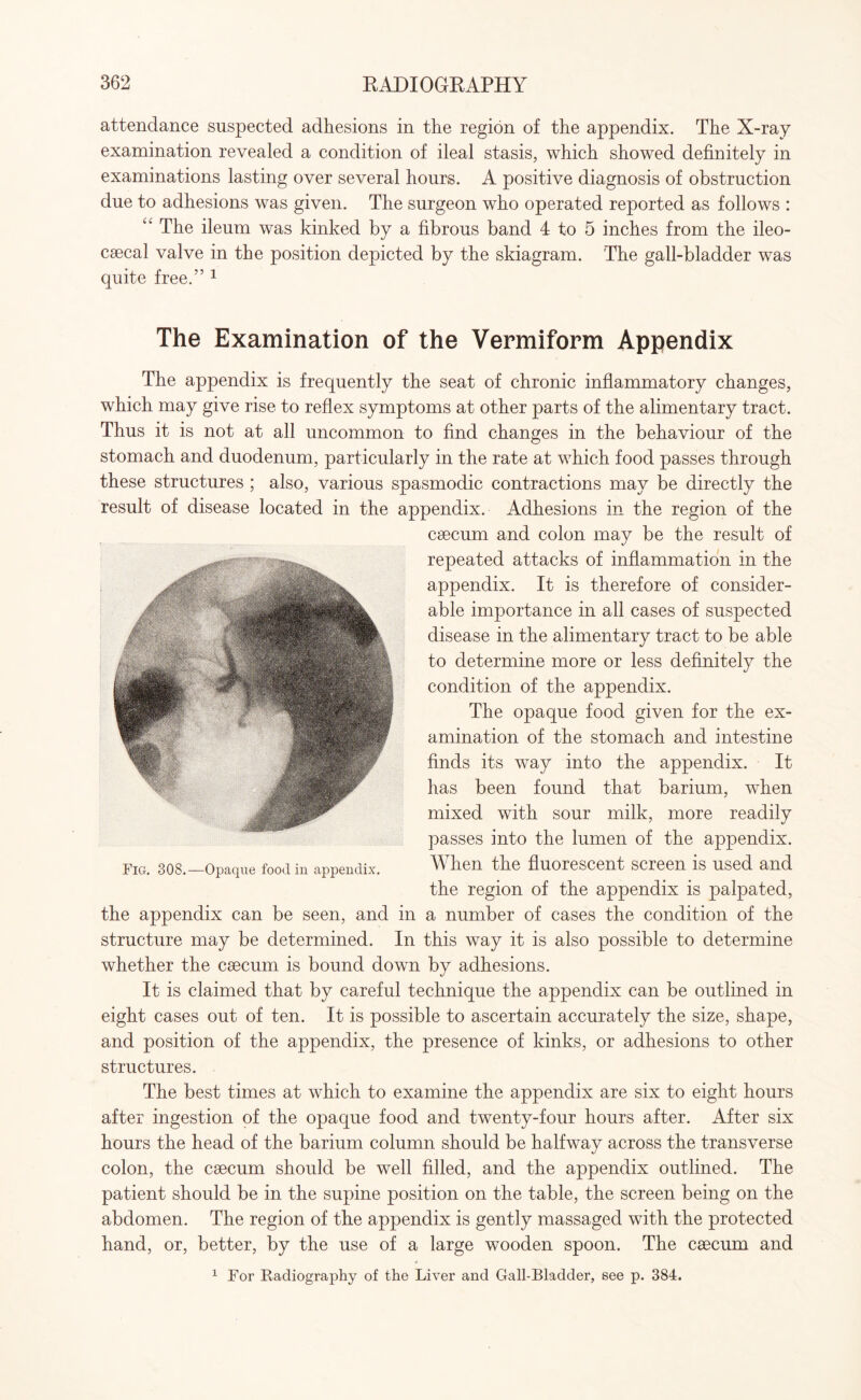 attendance suspected adhesions in the region of the appendix. The X-ray examination revealed a condition of ileal stasis, which showed definitely in examinations lasting over several hours. A positive diagnosis of obstruction due to adhesions was given. The surgeon who operated reported as follows : “ The ileum was kinked by a fibrous band 4 to 5 inches from the ileo- caecal valve in the position depicted by the skiagram. The gall-bladder was quite free.” 1 The Examination of the Vermiform Appendix The appendix is frequently the seat of chronic inflammatory changes, which may give rise to reflex symptoms at other parts of the alimentary tract. Thus it is not at all uncommon to find changes in the behaviour of the stomach and duodenum, particularly in the rate at which food passes through these structures ; also, various spasmodic contractions may be directly the result of disease located in the appendix. Adhesions in the region of the caecum and colon may be the result of repeated attacks of inflammation in the appendix. It is therefore of consider¬ able importance in all cases of suspected disease in the alimentary tract to be able to determine more or less definitely the condition of the appendix. The opaque food given for the ex¬ amination of the stomach and intestine finds its way into the appendix. It has been found that barium, when mixed with sour milk, more readily passes into the lumen of the appendix. When the fluorescent screen is used and the region of the appendix is palpated, the appendix can be seen, and in a number of cases the condition of the structure may be determined. In this way it is also possible to determine whether the caecum is bound down by adhesions. It is claimed that by careful technique the appendix can be outlined in eight cases out of ten. It is possible to ascertain accurately the size, shape, and position of the appendix, the presence of kinks, or adhesions to other structures. The best times at which to examine the appendix are six to eight hours after ingestion of the opaque food and twenty-four hours after. After six hours the head of the barium column should be halfway across the transverse colon, the caecum should be well filled, and the appendix outlined. The patient should be in the supine position on the table, the screen being on the abdomen. The region of the appendix is gently massaged with the protected hand, or, better, by the use of a large wooden spoon. The caecum and 1 For Radiography of the Liver and Gall-Bladder, see p. 384. Fig. 308.—Opaque food in appendix.