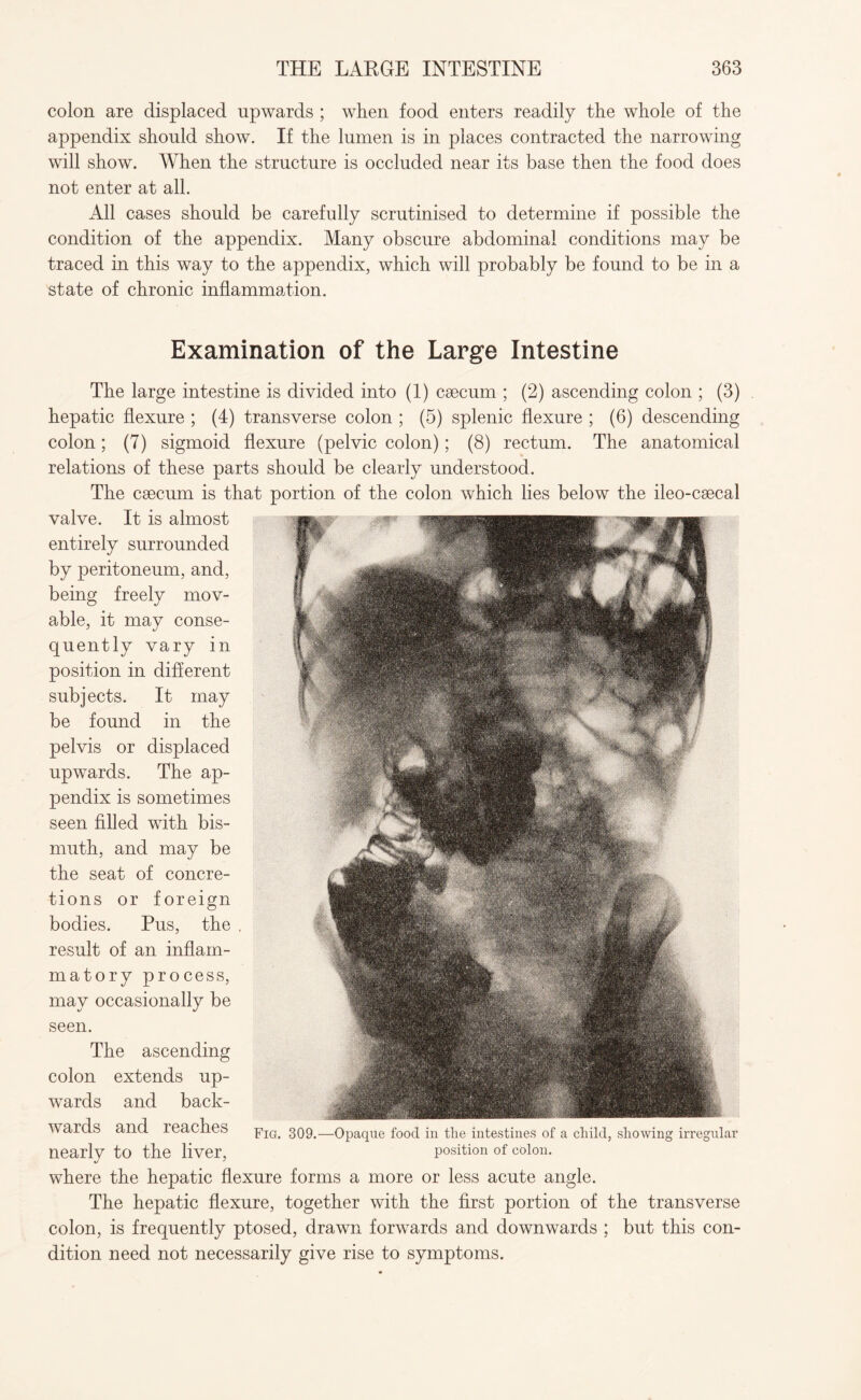 colon are displaced upwards ; when food enters readily the whole of the appendix should show. If the lumen is in places contracted the narrowing will show. When the structure is occluded near its base then the food does not enter at all. All cases should be carefully scrutinised to determine if possible the condition of the appendix. Many obscure abdominal conditions may be traced in this way to the appendix, which will probably be found to be in a state of chronic inflammation. Examination of the Large Intestine The large intestine is divided into (1) caecum ; (2) ascending colon ; (3) hepatic flexure ; (4) transverse colon ; (5) splenic flexure ; (6) descending colon; (7) sigmoid flexure (pelvic colon); (8) rectum. The anatomical relations of these parts should be clearly understood. The caecum is that portion of the colon which lies below the ileo-caecal valve. It is almost entirely surrounded by peritoneum, and, being freely mov¬ able, it may conse¬ quently vary in position in different subjects. It may be found in the pelvis or displaced upwards. The ap¬ pendix is sometimes seen filled with bis¬ muth, and may be the seat of concre¬ tions or foreign bodies. Pus, the result of an inflam- matory process, may occasionally be seen. The ascending colon extends up¬ wards and back¬ wards and reaches nearlv to the liver, where the hepatic flexure forms a more or less acute angle. The hepatic flexure, together with the first portion of the transverse colon, is frequently ptosed, drawn forwards and downwards ; but this con¬ dition need not necessarily give rise to symptoms. Fig. 309.—Opaque food in the intestines of a child, showing irregular position of colon.