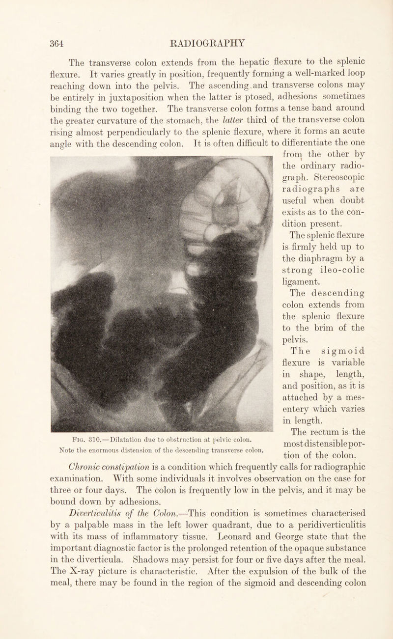 The transverse colon extends from the hepatic flexure to the splenic flexure. It varies greatly in position, frequently forming a well-marked loop reaching down into the pelvis. The ascending and transverse colons may be entirely in juxtaposition when the latter is ptosed, adhesions sometimes binding the two together. The transverse colon forms a tense band around the greater curvature of the stomach, the latter third of the transverse colon rising almost perpendicularly to the splenic flexure, where it forms an acute angle with the descending colon. It is often difficult to differentiate the one from the other by the ordinary radio¬ graph. Stereoscopic radiographs are useful when doubt exists as to the con¬ dition present. The splenic flexure is firmly held up to the diaphragm by a strong ileo-colic ligament. The descending colon extends from the splenic flexure to the brim of the pelvis. The sigmoid flexure is variable in shape, length, and position, as it is attached bv a mes- 1/ enterv which varies in length. The rectum is the most dist ensible por¬ tion of the colon. Chronic constipation is a condition which frequently calls for radiographic examination. With some individuals it involves observation on the case for three or four days. The colon is frequently low in the pelvis, and it may be bound down by adhesions. Diverticulitis of the Colon.—'This condition is sometimes characterised by a palpable mass in the left lower quadrant, due to a peridiverticulitis with its mass of inflammatory tissue. Leonard and George state that the important diagnostic factor is the prolonged retention of the opaque substance in the diverticula. Shadows may persist for four or five days after the meal. The X-ray picture is characteristic. After the expulsion of the bulk of the meal, there may be found in the region of the sigmoid and descending colon Fig. 310.—Dilatation due to obstruction at pelvic colon. Note the enormous distension of the descending transverse colon.