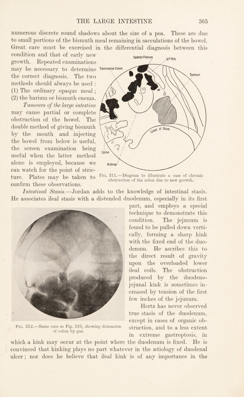 numerous discrete round shadows about the size of a pea. These are due to small portions of the bismuth meal remaining in sacculations of the bowel. Great care must be exercised in the differential diagnosis between this condition and that of early new growth. Repeated examinations may be necessary to determine the correct diagnosis. The two methods should always be used : (1) The ordinary opaque meal ; (2) the barium or bismuth enema. Tumours of the large intestine may cause partial or complete obstruction of the bowel. The double method of giving bismuth by the mouth and injecting the bowel from below is useful, the screen examination being useful when the latter method alone is employed, because we can watch for the point of stric¬ ture. Plates mav be taken to confirm these observations. Intestinal Stasis.—Jordan adds to the knowledge of intestinal stasis. He associates ileal stasis with a distended duodenum, especially in its first part, and employs a special technique to demonstrate this condition. The jejunum is found to be pulled down verti¬ cally, forming a sharp kink with the fixed end of the duo¬ denum. He ascribes this to the direct result of gravity upon the overloaded lower ileal coils. The obstruction produced by the duodeno¬ jejunal kink is sometimes in¬ creased by tension of the first few inches of the jejunum. Hertz has never observed true stasis of the duodenum, except in cases of organic ob¬ struction, and to a less extent in extreme gastroptosis, in which a kink may occur at the point where the duodenum is fixed. He is convinced that kinking plays no part whatever in the aetiology of duodenal ulcer ; nor does he believe that ileal kink is of any importance in the Fig. 312.—Same case as Fig. 310, showing distension of colon by gas. Splenic Flexure Fig. 311.—Diagram to illustrate a case of chronic obstruction of the colon due to new growth.