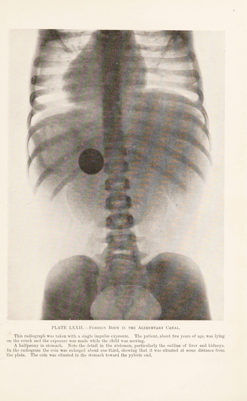 PLATE LXXII.—Foreign Body in the Alimentary Canal. This radiograph was taken with a single impulse exposure. The patient, about five years of age, was lying on the couch and the exposure was made while the child was moving. A halfpenny in stomach. Note the detail in the abdomen, particularly the outline of liver and kidneys. In the radiogram the coin was enlarged about one-third, showing that it was situated at some distance from the plate. The coin was situated in the stomach toward the pyloric end.