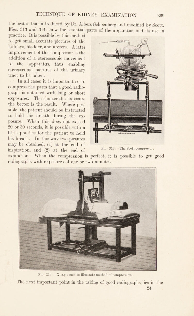 TECHNIQUE OF KIDNEY EXAMINATION the best is that introduced by Dr. Albers Schoenberg and modified by Scott. Figs. 313 and 314 show the essential parts of the apparatus, and its use in practice. It is possible by this method to get small accurate pictures of the kidneys, bladder, and ureters. A later improvement of this compressor is the addition of a stereoscopic movement to the apparatus, thus enabling stereoscopic pictures of the urinary tract to be taken. In all cases it is important so to compress the parts that a good radio¬ graph is obtained with long or short exposures. The shorter the exposure the better is the result. Where pos¬ sible, the patient should be instructed to hold his breath during the ex¬ posure. When this does not exceed 20 or 30 seconds, it is possible with a little practice for the patient to hold his breath. In this way two pictures may be obtained, (1) at the end of inspiration, and (2) at the end of FlG' S13'-Tlle Scott compressor. expiration. When the compression is perfect, it is possible to get good radiographs with exposures of one or two minutes. Fig. 314.—X-ray couch to illustrate method of compression. The next important point in the taking of good radiographs lies in the 24