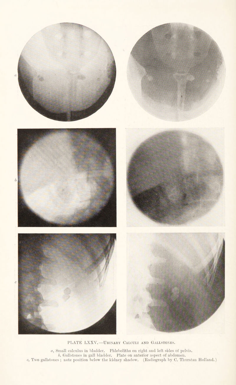 a, Small calculus in bladder. Phlebolitlis on right and left sides of pelvis. 6, Gallstones in gall bladder. Plate on anterior aspect of abdomen. c, Two gallstones ; note position below the kidney shadow. (Radiograph by C. Thurstan Holland.)
