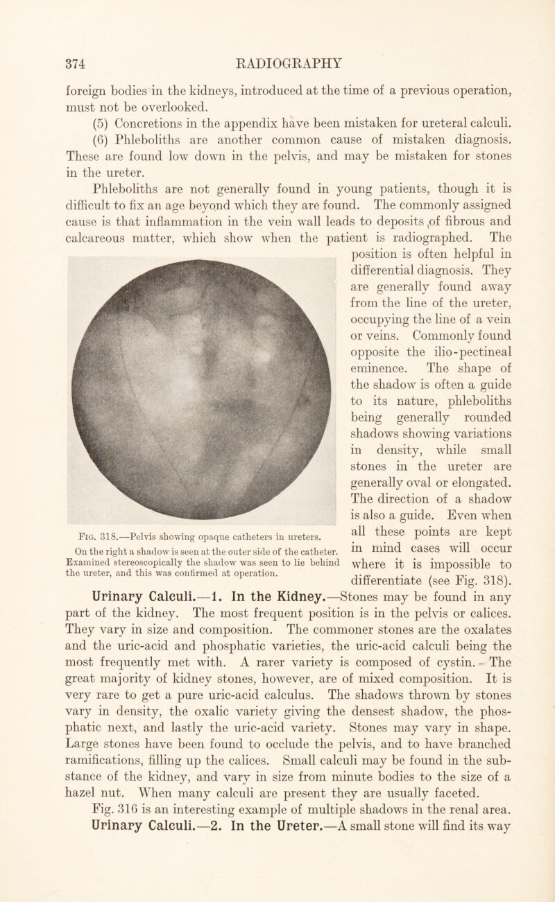 foreign bodies in the kidneys, introduced at the time of a previous operation, must not be overlooked. (5) Concretions in the appendix have been mistaken for ureteral calculi. (6) Phleboliths are another common cause of mistaken diagnosis. These are found low down in the pelvis, and may be mistaken for stones in the ureter. Phleboliths are not generally found in young patients, though it is difficult to fix an age beyond which they are found. The commonly assigned cause is that inflammation in the vein wall leads to deposits ,of fibrous and calcareous matter, which show when the patient is radiographed. The position is often helpful in differential diagnosis. They are generally found away from the line of the ureter, occupying the line of a vein or veins. Commonly found opposite the ilio-pectineal eminence. The shape of the shadow is often a guide to its nature, phleboliths being generally rounded shadows showing variations in density, while small stones in the ureter are generally oval or elongated. The direction of a shadow is also a guide. Even when all these points are kept in mind cases will occur where it is impossible to differentiate (see Fig. 318). Urinary Calculi.—1. In the Kidney.—Stones may be found in any part of the kidney. The most frequent position is in the pelvis or calices. They vary in size and composition. The commoner stones are the oxalates and the uric-acid and phosphatic varieties, the uric-acid calculi being the most frequently met with. A rarer variety is composed of cystin. - The great majority of kidney stones, however, are of mixed composition. It is very rare to get a pure uric-acid calculus. The shadows thrown by stones vary in density, the oxalic variety giving the densest shadow, the phos¬ phatic next, and lastly the uric-acid variety. Stones may vary in shape. Large stones have been found to occlude the pelvis, and to have branched ramifications, filling up the calices. Small calculi may be found in the sub¬ stance of the kidney, and vary in size from minute bodies to the size of a hazel nut. When many calculi are present they are usually faceted. Fig. 316 is an interesting example of multiple shadows in the renal area. Urinary Calculi.—2. In the Ureter.—A small stone will find its way Fig. 318.—Pelvis showing opaque catheters in ureters. On the right a shadow is seen at the outer side of the catheter. Examined stereoscopically the shadow was seen to lie behind the ureter, and this was confirmed at operation.