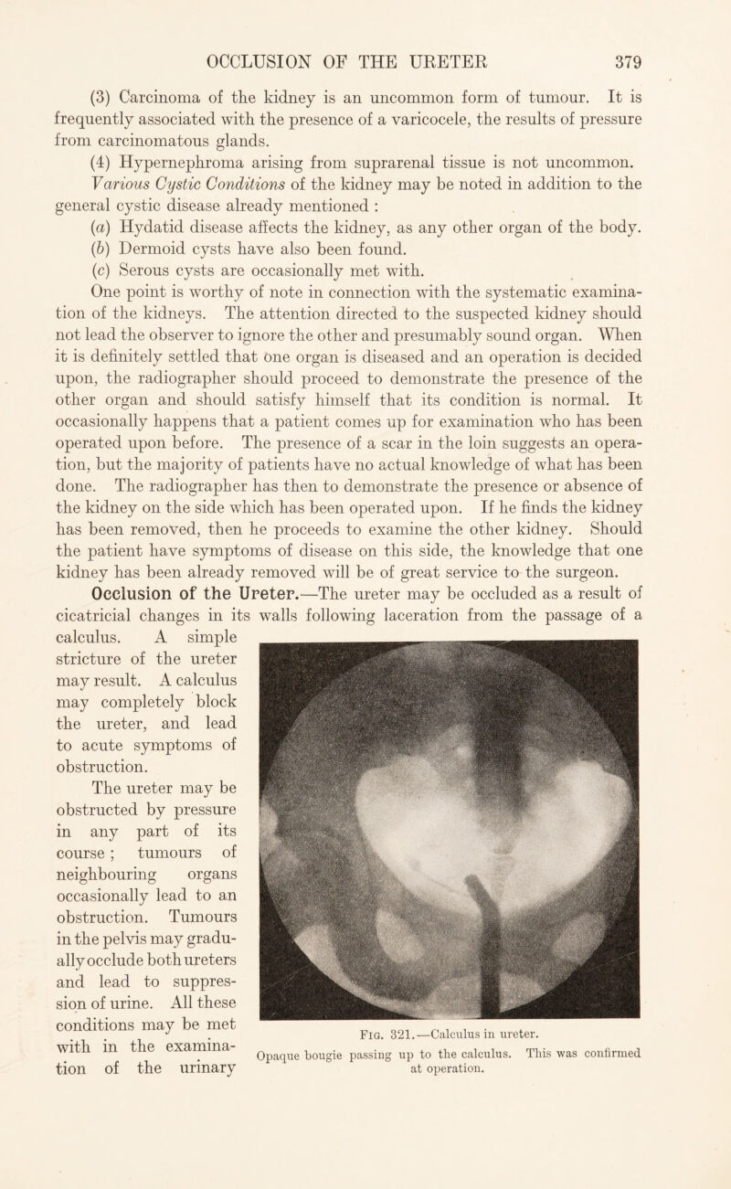 (3) Carcinoma of the kidney is an uncommon form of tumour. It is frequently associated with the presence of a varicocele, the results of pressure from carcinomatous glands. (4) Hypernephroma arising from suprarenal tissue is not uncommon. Various Cystic Conditions of the kidney may be noted in addition to the general cystic disease already mentioned : (а) Hydatid disease affects the kidney, as any other organ of the body. (б) Dermoid cysts have also been found. (c) Serous cysts are occasionally met with. One point is worthy of note in connection with the systematic examina¬ tion of the kidneys. The attention directed to the suspected kidney should not lead the observer to ignore the other and presumably sound organ. When it is definitely settled that one organ is diseased and an operation is decided upon, the radiographer should proceed to demonstrate the presence of the other organ and should satisfy himself that its condition is normal. It occasionally happens that a patient comes up for examination who has been operated upon before. The presence of a scar in the loin suggests an opera¬ tion, but the majority of patients have no actual knowledge of what has been done. The radiographer has then to demonstrate the presence or absence of the kidney on the side which has been operated upon. If he finds the kidney has been removed, then he proceeds to examine the other kidney. Should the patient have symptoms of disease on this side, the knowledge that one kidney has been already removed will be of great service to the surgeon. Occlusion of the Ureter.—The ureter may be occluded as a result of cicatricial changes in its walls following laceration from the passage of a calculus. A simple stricture of the ureter may result. A calculus may completely block the ureter, and lead to acute symptoms of obstruction. The ureter may be obstructed by pressure in any part of its course ; tumours of neighbouring organs occasionally lead to an obstruction. Tumours in the pelvis may gradu¬ ally occlude both ureters and lead to suppres¬ sion of urine. All these conditions may be met with in the examina¬ tion of the urinary Fig. 321.—Calculus in ureter. Opaque bougie passing up to the calculus. at operation. This was confirmed