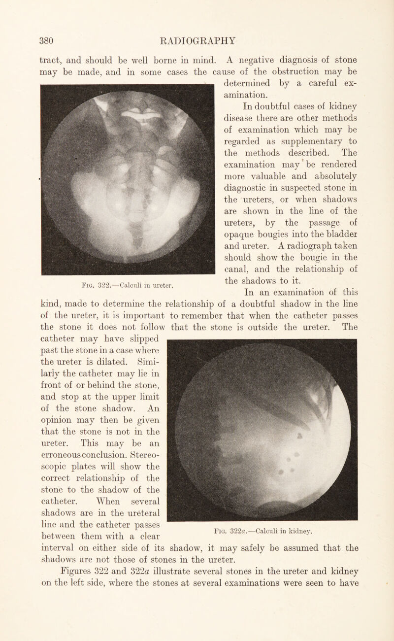 tract, and should be well borne in mind. A negative diagnosis of stone may be made, and in some cases the cause of the obstruction may be determined by a careful ex¬ amination. In doubtful cases of kidney disease there are other methods of examination which may be regarded as supplementary to the methods described. The examination may be rendered more valuable and absolutely diagnostic in suspected stone in the ureters, or when shadows are shown in the line of the ureters, by the passage of opaque bougies into the bladder and ureter. A radiograph taken should show the bougie in the canal, and the relationship of the shadows to it. In an examination of this kind, made to determine the relationship of a doubtful shadow in the line of the ureter, it is important to remember that when the catheter passes the stone it does not follow that the stone is outside the ureter. The catheter may have slipped past the stone in a case where the ureter is dilated. Simi¬ larly the catheter may lie in front of or behind the stone, and stop at the upper limit of the stone shadow. An opinion may then be given that the stone is not in the ureter. This may be an erroneous conclusion. Stereo¬ scopic plates will show the correct relationship of the stone to the shadow of the catheter. When several shadows are in the ureteral line and the catheter passes between them with a dear interval on either side of its shadow, it may safely be assumed that the shadows are not those of stones in the ureter. Figures 322 and 322a illustrate several stones in the ureter and kidney on the left side, where the stones at several examinations were seen to have
