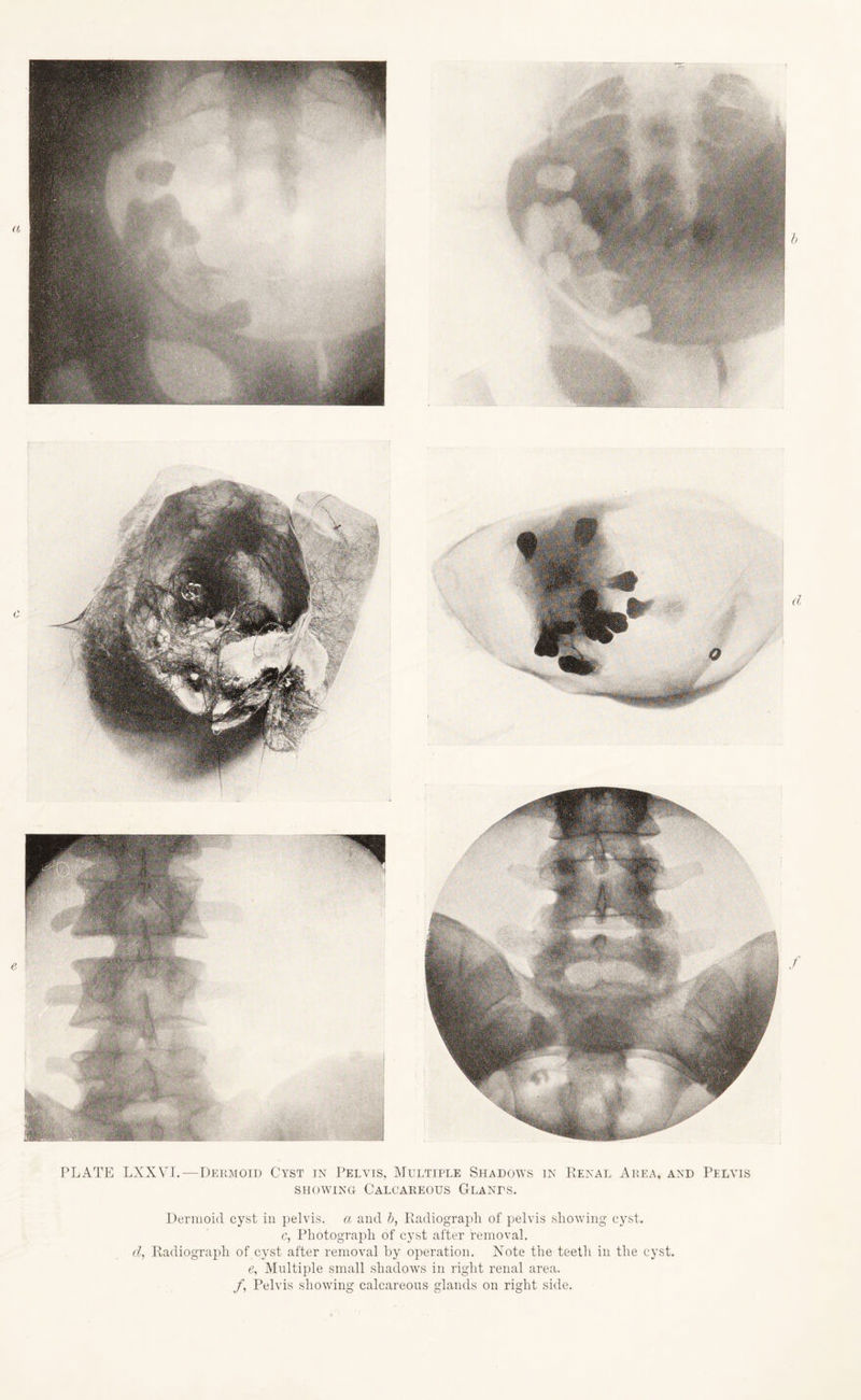 PLATE LXXVI. — Dermoid Cyst in Pelvis, Multiple Shadows in Renal Area, and Pelvis showing Calcareous Glands. Dermoid cyst in pelvis, a and b, Radiograph of pelvis showing cyst. c, Photograph of cyst after removal. cl, Radiograph of cyst after removal by operation. Note the teeth in the cyst. e, Multiple small shadows in right renal area. /, Pelvis showing calcareous glands on right side.
