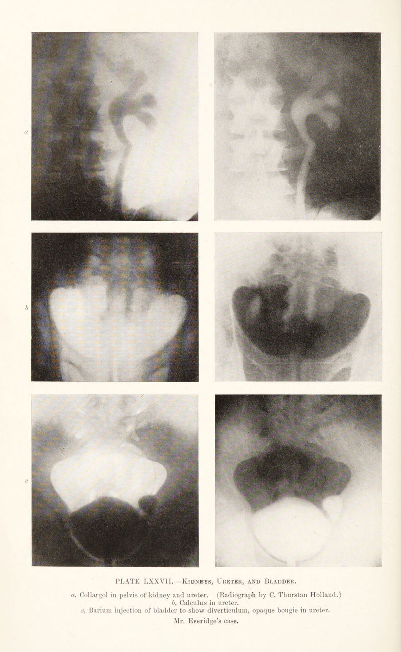 PLATE LXXVII.—Kidneys, Ureter, and Bladder. a, Collargol in pelvis of kidney and ureter. (Radiograph by C. Thurstan Holland.) b, Calculus in ureter. c, Barium injection of bladder to show diverticulum, opaque bougie in ureter. Mr. Everidge’s case.