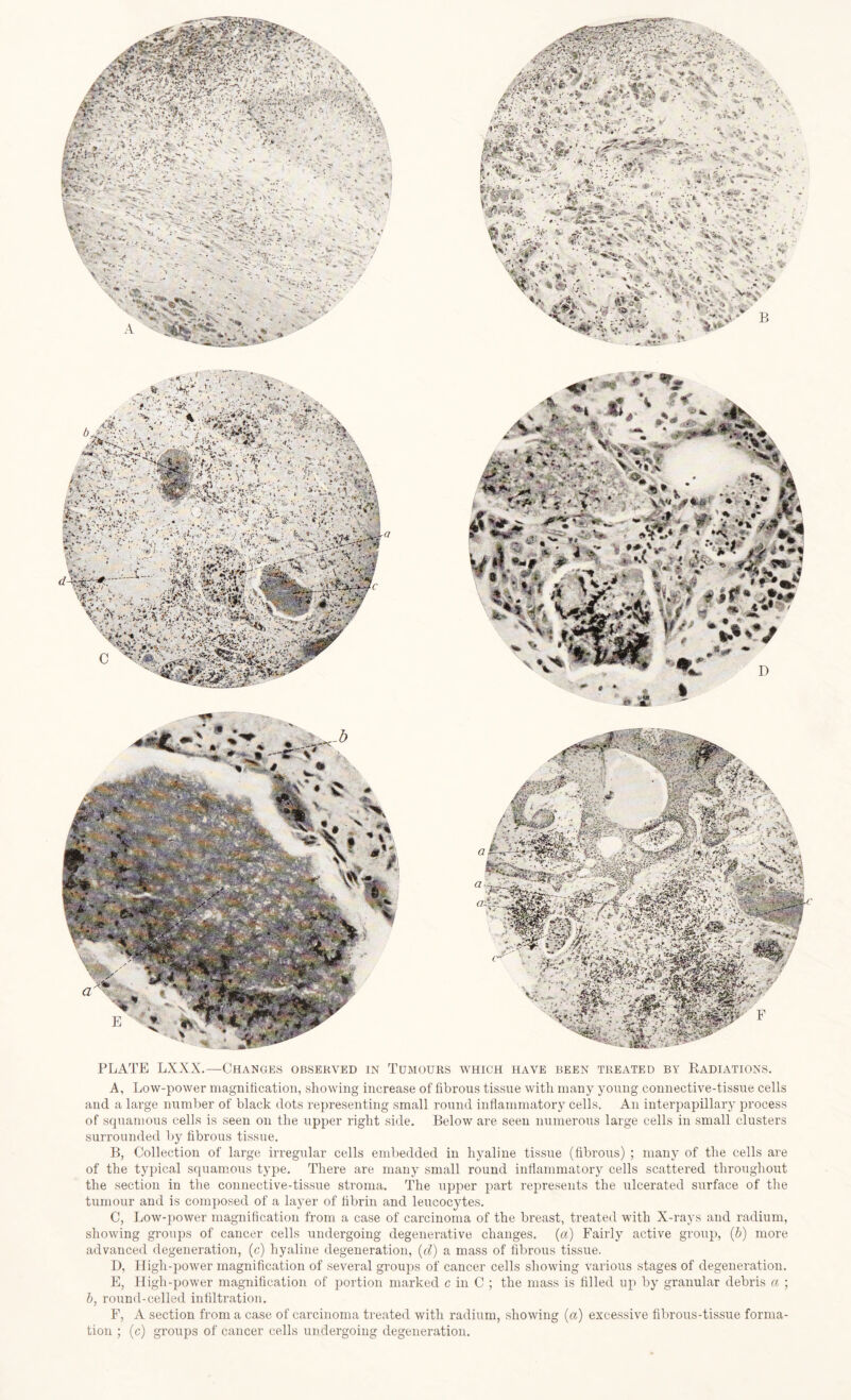 A, Low-power magnification, showing increase of fibrous tissue with many young connective-tissue cells and a large number of black dots representing small round inflammatory cells. An interpapillary process of squamous cells is seen on the upper right side. Below are seen numerous large cells in small clusters surrounded by fibrous tissue. B, Collection of large irregular cells embedded in hyaline tissue (fibrous) ; many of the cells are of the typical squamous type. There are many small round inflammatory cells scattered throughout the section in the connective-tissue stroma. The upper part represents the ulcerated surface of the tumour and is composed of a layer of fibrin and leucocytes. C, Low-power magnification from a case of carcinoma of the breast, treated with X-rays and radium, showing groups of cancer cells undergoing degenerative changes, (a) Fairly active group, (b) more advanced degeneration, (c) hyaline degeneration, (d) a mass of fibrous tissue. D, Higli-power magnification of several groups of cancer cells showing various stages of degeneration. E, High-power magnification of portion marked c in C ; the mass is filled up by granular debris a ; b, round-celled infiltration. F, A section from a case of carcinoma treated with radium, showing (a) excessive fibrous-tissue forma¬ tion ; (c) groups of cancer cells undergoing degeneration.