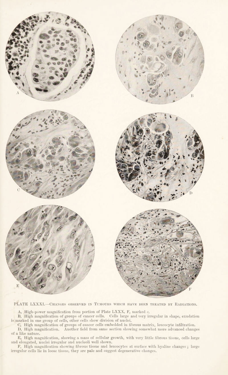 A, High-power magnification from portion of Plate LXXX, F, marked c. B, High magnification of groups of cancer cells. Cells large and very irregular in shape, exudation is marked in one group of cells, other cells show division of nuclei. C, High magnification of groups of cancer cells embedded in fibrous matrix, leucocyte infiltration. I), High magnification. Another field from same section showing somewhat more advanced changes of a like nature. E, High magnification, showing a mass of cellular growth, with very little fibrous tissue, cells large and elongated, nuclei irregular and nucleoli well shown. F, High magnification showing fibrous tissue and leucocytes at surface witli hyaline changes ; large irregular cells lie in loose tissue, they are pale and suggest degenerative changes.