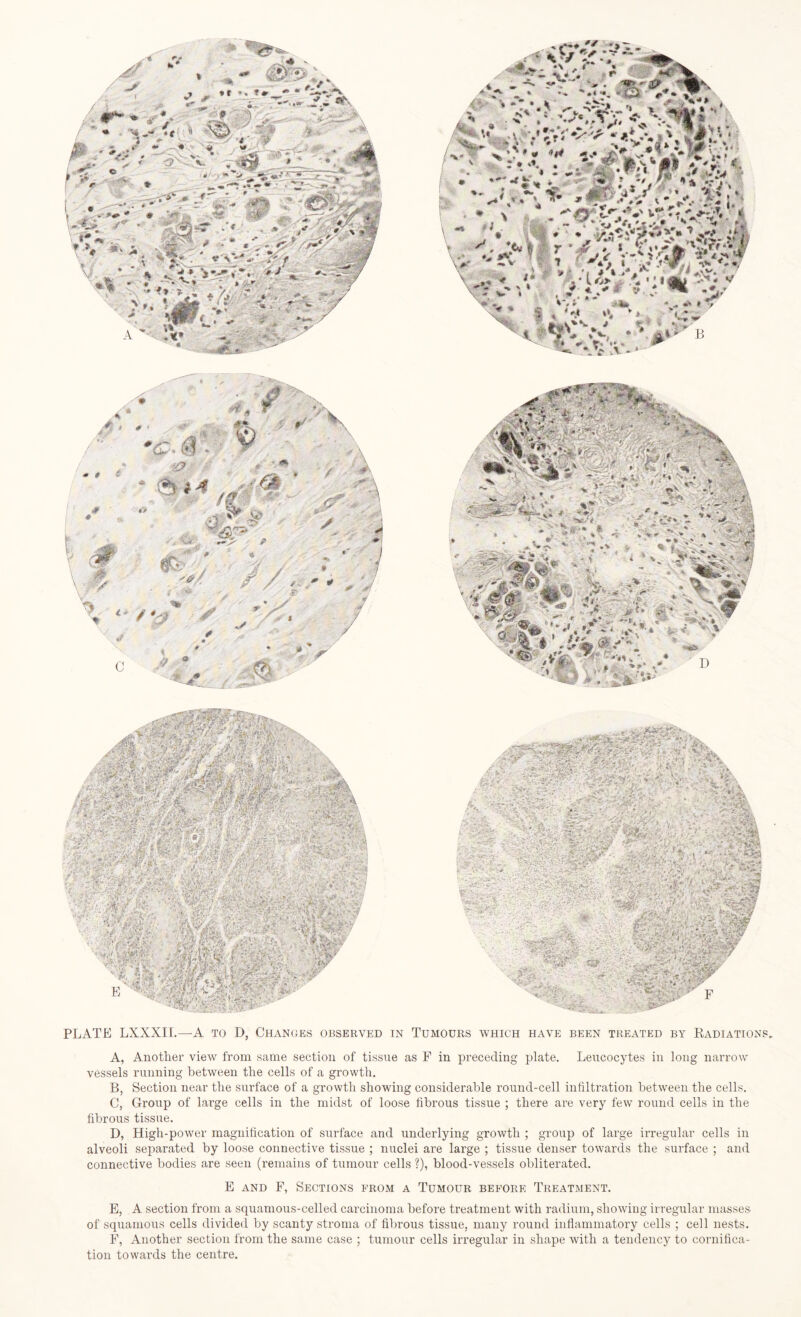 A, Another view from same section of tissue as F in preceding plate. Leucocytes in long narrow vessels running between the cells of a growth. B, Section near the surface of a growth showing considerable round-cell infiltration between the cells. C, Group of large cells in the midst of loose fibrous tissue ; there are very few round cells in the fibrous tissue. D, High-power magnification of surface and underlying growth ; group of large irregular cells in alveoli separated by loose connective tissue ; nuclei are large ; tissue denser towards the surface ; and connective bodies are seen (remains of tumour cells ?), blood-vessels obliterated. E and F, Sections from a Tumour before Treatment. E, A section from a squamous-celled carcinoma before treatment with radium, showing irregular masses of squamous cells divided by scanty stroma of fibrous tissue, many round inflammatory cells ; cell nests. F, Another section from the same case ; tumour cells irregular in shape with a tendency to cornifica- tion towards the centre.