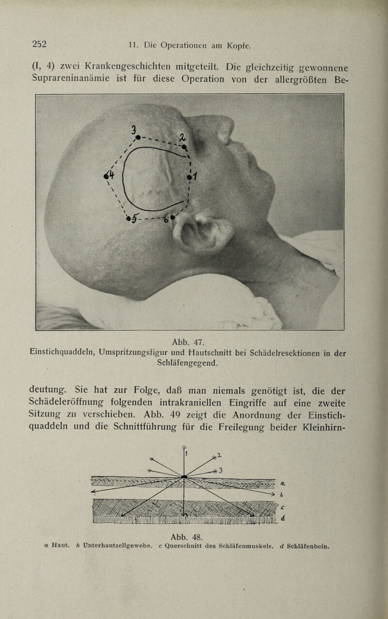 (1, 4) zwei Krankengeschichten mitgeteilt. Die gleichzeitig gewonnene Suprareninanämie ist für diese Operation von der allergrößten Be- Abb. 47. Einstichquaddeln, Umspritzungsfigur und Hautschnitt bei Schädelresektionen in der Schläfengegend. deutung. Sie hat zur Folge, daß man niemals genötigt ist, die der Schädeleröffnung folgenden intrakraniellen Eingriffe auf eine zweite Sitzung zu verschieben. Abb. 49 zeigt die Anordnung der Einstich¬ quaddeln und die Schnittführung für die Freilegung beider Kleinhirn- Abb. 48. Haut, b Unterhautzellgewebe, c Querschnitt des Schläfenmuskels, d Schläfenbein.