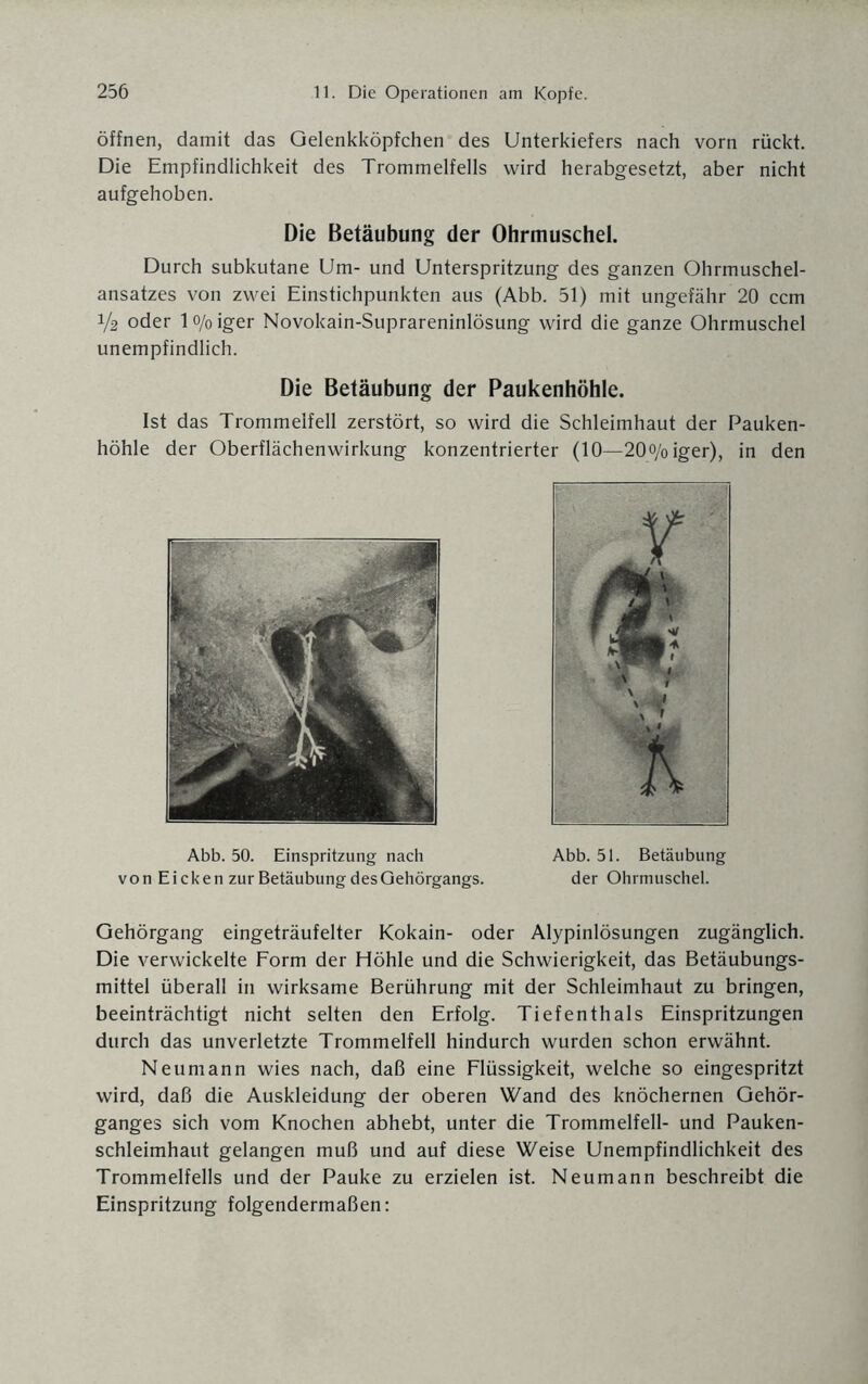 öffnen, damit das Gelenkköpfchen des Unterkiefers nach vorn rückt. Die Empfindlichkeit des Trommelfells wird herabgesetzt, aber nicht aufgehoben. Die Betäubung der Ohrmuschel. Durch subkutane Um- und Unterspritzung des ganzen Ohrmuschel¬ ansatzes von zwei Einstichpunkten aus (Abb. 51) mit ungefähr 20 ccm 1/2 oder lo/oiger Novokain-Suprareninlösung wird die ganze Ohrmuschel unempfindlich. Die Betäubung der Paukenhöhle. Ist das Trommelfell zerstört, so wird die Schleimhaut der Pauken¬ höhle der Oberflächenwirkung konzentrierter (10—20o/oiger), in den Gehörgang eingeträufelter Kokain- oder Alypinlösungen zugänglich. Die verwickelte Form der Höhle und die Schwierigkeit, das Betäubungs¬ mittel überall in wirksame Berührung mit der Schleimhaut zu bringen, beeinträchtigt nicht selten den Erfolg. Tiefenthals Einspritzungen durch das unverletzte Trommelfell hindurch wurden schon erwähnt. Neumann wies nach, daß eine Flüssigkeit, welche so eingespritzt wird, daß die Auskleidung der oberen Wand des knöchernen Gehör¬ ganges sich vom Knochen abhebt, unter die Trommelfell- und Pauken¬ schleimhaut gelangen muß und auf diese Weise Unempfindlichkeit des Trommelfells und der Pauke zu erzielen ist. Neu mann beschreibt die Einspritzung folgendermaßen: