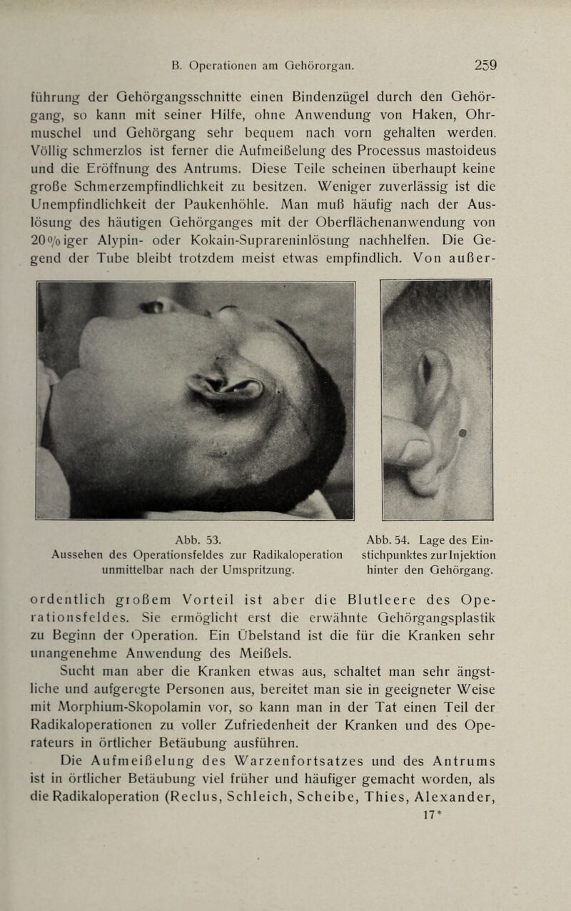 fiihrung der Gehörgangsschnitte einen Bindenzügel durch den Gehör¬ gang, so kann mit seiner Hilfe, ohne Anwendung von Haken, Ohr¬ muschel und Gehörgang sehr bequem nach vorn gehalten werden. Völlig schmerzlos ist ferner die Aufmeißelung des Processus mastoideus und die Eröffnung des Antrums. Diese Teile scheinen überhaupt keine große Schmerzempfindlichkeit zu besitzen. Weniger zuverlässig ist die Unempfindlichkeit der Paukenhöhle. Man muß häufig nach der Aus¬ lösung des häutigen Gehörganges mit der Oberflächenanwendung von 20o/oiger Alypin- oder Kokain-Suprareninlösung nachhelfen. Die Ge¬ gend der Tube bleibt trotzdem meist etwas empfindlich. Von außer- Abb. 53. Abb. 54. Lage des Ein- Aussehen des Operationsfeldes zur Radikaloperation stichpunktes zur Injektion unmittelbar nach der Umspritzung. hinter den Gehörgang. ordentlich großem Vorteil ist aber die Blutleere des Ope¬ rationsfeldes. Sie ermöglicht erst die erwähnte Gehörgangsplastik zu Beginn der Operation. Ein Übelstand ist die für die Kranken sehr unangenehme Anwendung des Meißels. Sucht man aber die Kranken etwas aus, schaltet man sehr ängst¬ liche und aufgeregte Personen aus, bereitet man sie in geeigneter Weise mit Morphium-Skopolamin vor, so kann man in der Tat einen Teil der Radikaloperationen zu voller Zufriedenheit der Kranken und des Ope¬ rateurs in örtlicher Betäubung ausführen. Die Aufmeißelung des Warzenfortsatzes und des Antrums ist in örtlicher Betäubung viel früher und häufiger gemacht worden, als die Radikaloperation (Reclus, Schleich, Scheibe, Thies, Alexander, 17*