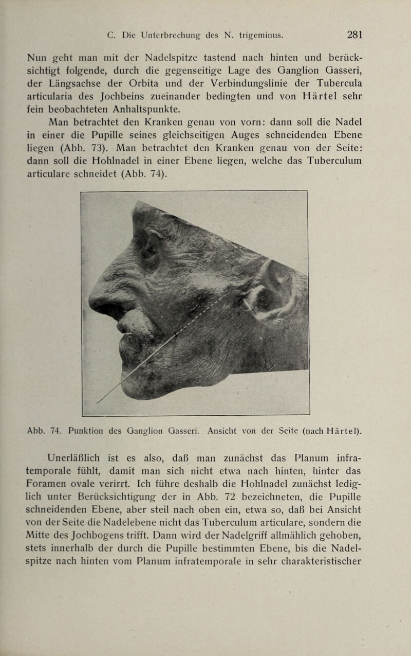 Nun geht man mit der Nadelspitze tastend nach hinten und berück¬ sichtigt folgende, durch die gegenseitige Lage des Ganglion Gasseri, der Längsachse der Orbita und der Verbindungslinie der Tubercula articularia des Jochbeins zueinander bedingten und von Härtel sehr fein beobachteten Anhaltspunkte. Man betrachtet den Kranken genau von vorn: dann soll die Nadel in einer die Pupille seines gleichseitigen Auges schneidenden Ebene liegen (Abb. 73). Man betrachtet den Kranken genau von der Seite: dann soll die Hohlnadel in einer Ebene liegen, welche das Tuberculum articulare schneidet (Abb. 74). Abb. 74. Punktion des Ganglion Gasseri. Ansicht von der Seite (nach Härtel). Unerläßlich ist es also, daß man zunächst das Planum infra¬ temporale fühlt, damit man sich nicht etwa nach hinten, hinter das Foramen ovale verirrt. Ich führe deshalb die Hohlnadel zunächst ledig¬ lich unter Berücksichtigung der in Abb. 72 bezeichneten, die Pupille schneidenden Ebene, aber steil nach oben ein, etwa so, daß bei Ansicht von der Seite die Nadelebene nicht das Tuberculum articulare, sondern die Mitte des Jochbogens trifft. Dann wird der Nadelgriff allmählich gehoben, stets innerhalb der durch die Pupille bestimmten Ebene, bis die Nadel¬ spitze nach hinten vom Planum infratemporale in sehr charakteristischer