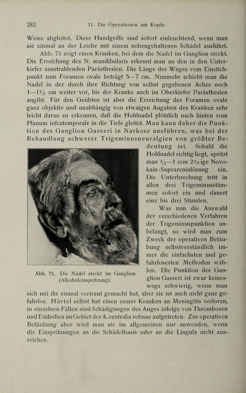 Weise abgleitet. Diese Handgriffe sind sofort einleuchtend, wenn man sie einmal an der Leiche mit einem nebengehaltenen Schädel ausführt. Abb. 75 zeigt einen Kranken, bei dem die Nadel im Ganglion steckt. Die Erreichung des N. mandibularis erkennt man an den in den Unter¬ kiefer ausstrahlenden Parästhesien. Die Länge des Weges vom Einstich¬ punkt zum Foramen ovale beträgt 5—7 cm. Nunmehr schiebt man die Nadel in der durch ihre Richtung von selbst gegebenen Achse noch 1—11/2 cm weiter vor, bis der Kranke auch im Oberkiefer Parästhesien angibt. Für den Geübten ist aber die Erreichung des Foramen ovale ganz objektiv und unabhängig von etwaigen Angaben des Kranken sehr leicht daran zu erkennen, daß die Hohlnadel plötzlich nach hinten vom Planum infratemporale in die Tiefe gleitet. Man kann daher die Punk¬ tion des Ganglion Gasseri in Narkose ausführen, was bei der Behandlung schwerer Trigeminusneuralgien von größter Be¬ deutung ist. Sobald die Hohlnadel richtig liegt, spritzt man 1/2—1 ccm 2o/oige Novo- kain-Suprareninlösung ein. Die Unterbrechung tritt in allen drei Trigeminusstäm¬ men sofort ein und dauert eine bis drei Stunden. Was nun die Auswahl der verschiedenen Verfahren der Trigeminuspunktion an¬ belangt, so wird man zum Zweck der operativen Betäu¬ bung selbstverständlich im¬ mer die einfachsten und ge¬ fahrlosesten Methoden wäh¬ len. Die Punktion des Gan¬ glion Gasseri ist zwar keines¬ wegs schwierig, wenn man sich mit ihr einmal vertraut gemacht hat, aber sie ist auch nicht ganz ge¬ fahrlos. Härtel selbst hat einen seiner Kranken an Meningitis verloren, in einzelnen Fällen sind Schädigungen des Auges infolge von Thrombosen und Embolien imGebiet der A. centralis retinae aufgetreten. Zur operativen Betäubung aber wird man sie im allgemeinen nur anwenden, wenn die Einspritzungen an die Schädelbasis oder an die Lingula nicht aus¬ reichen. Abb. 75. Die Nadel steckt im Ganglion (Alkoholeinspritzung).