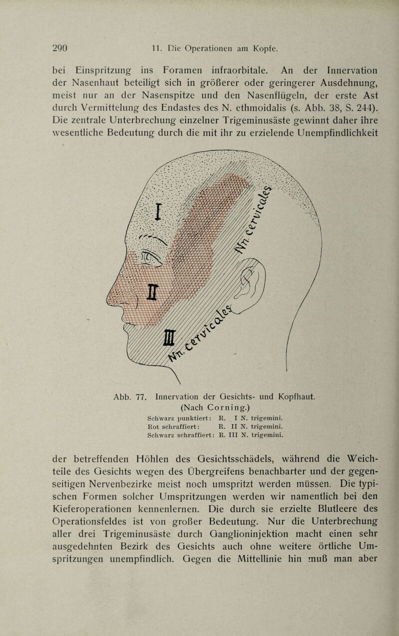 bei Einspritzung ins Foramen infraorbitale. An der Innervation der Nasenhaut beteiligt sich in größerer oder geringerer Ausdehnung, meist nur an der Nasenspitze und den Nasenflügeln, der erste Ast durch Vermittelung des Endastes des N. ethmoidalis (s. Abb. 38, S. 244). Die zentrale Unterbrechung einzelner Trigeminusäste gewinnt daher ihre wesentliche Bedeutung durch die mit ihr zu erzielende Unempfindlichkeit Abb. 77. Innervation der Gesichts- und Kopfhaut. (Nach Corning.) Schwarz punktiert: R. IN. trigemini. Rot schraffiert: R. II N. trigemini. Schwarz schraffiert: R. III N. trigemini. der betreffenden Höhlen des Gesichtsschädels, während die Weich¬ teile des Gesichts wegen des Übergreifens benachbarter und der gegen¬ seitigen Nervenbezirke meist noch umspritzt werden müssen. Die typi¬ schen Formen solcher Umspritzungen werden wir namentlich bei den Kieferoperationen kennenlernen. Die durch sie erzielte Blutleere des Operationsfeldes ist von großer Bedeutung. Nur die Unterbrechung aller drei Trigeminusäste durch Ganglioninjektion macht einen sehr ausgedehnten Bezirk des Gesichts auch ohne weitere örtliche Um¬ spritzungen unempfindlich. Gegen die Mittellinie hin muß man aber