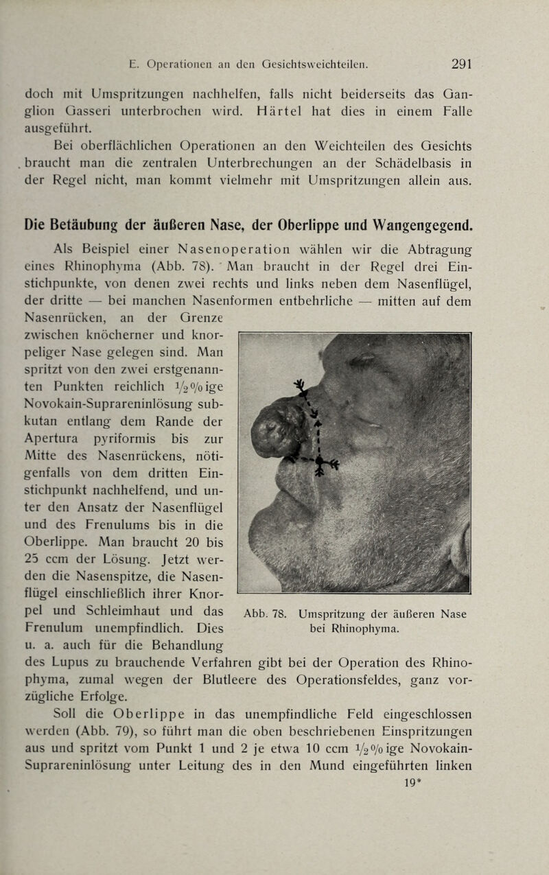 doch mit Umspritzungen nachhelfen, falls nicht beiderseits das Gan¬ glion Gasseri unterbrochen wird. Härtel hat dies in einem Falle ausgeführt. Bei oberflächlichen Operationen an den Weichteilen des Gesichts braucht man die zentralen Unterbrechungen an der Schädelbasis in der Regel nicht, man kommt vielmehr mit Umspritzungen allein aus. Die Betäubung der äußeren Nase, der Oberlippe und Wangengegend. Als Beispiel einer Nasenoperation wählen wir die Abtragung eines Rhinophyma (Abb. 78). Man braucht in der Regel drei Ein¬ stichpunkte, von denen zwei rechts und links neben dem Nasenflügel, der dritte — bei manchen Nasenformen entbehrliche — mitten auf dem Nasenrücken, an der Grenze zwischen knöcherner und knor¬ peliger Nase gelegen sind. Man spritzt von den zwei erstgenann¬ ten Punkten reichlich V2%ige Novokain-Suprareninlösung sub¬ kutan entlang dem Rande der Apertura pyriformis bis zur Mitte des Nasenrückens, nöti¬ genfalls von dem dritten Ein¬ stichpunkt nachhelfend, und un¬ ter den Ansatz der Nasenflügel und des Frenulums bis in die Oberlippe. Man braucht 20 bis 25 ccm der Lösung. Jetzt wer¬ den die Nasenspitze, die Nasen¬ flügel einschließlich ihrer Knor¬ pel und Schleimhaut und das Frenulum unempfindlich. Dies u. a. auch für die Behandlung des Lupus zu brauchende Verfahren gibt bei der Operation des Rhino¬ phyma, zumal wegen der Blutleere des Operationsfeldes, ganz vor¬ zügliche Erfolge. Soll die Oberlippe in das unempfindliche Feld eingeschlossen werden (Abb. 79), so führt man die oben beschriebenen Einspritzungen aus und spritzt vom Punkt 1 und 2 je etwa 10 ccm V20/oige Novokain- Suprareninlösung unter Leitung des in den Mund eingeführten linken 19*
