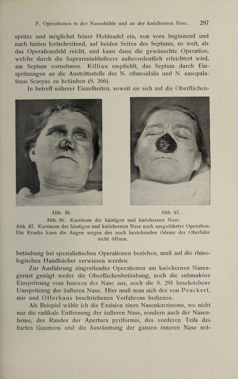 spritze und möglichst feiner Hohlnadel ein, von vorn beginnend und nach hinten fortschreitend, auf beiden Seiten des Septums, so weit, als das Operationsfeld reicht, und kann dann die gewünschte Operation, welche durch die Suprareninblutleere außerordentlich erleichtert wird, am Septum vornehmen. Killian empfiehlt, das Septum durch Ein¬ spritzungen an die Austrittsstelle des N. ethmoidalis und N. nasopala- tinus Scarpae zu betäuben (S. 266). In betreff näherer Einzelheiten, soweit sie sich auf die Oberflächen- Abb. 86. Abb. 87. Abb. 86. Karzinom der häutigen und knöchernen Nase. Abb. 87. Karzinom der häutigen und knöchernen Nase nach ausgeführter Operation. Die Kranke kann die Augen wegen des noch bestehenden Ödems der Oberlider nicht öffnen. betäubung bei spezialistischen Operationen beziehen, muß auf die rhino- logischen Handbücher verwiesen werden. Zur Ausführung eingreifender Operationen am knöchernen Nasen¬ gerüst genügt weder die Oberflächenbetäubung, noch die submuköse Einspritzung vom Inneren der Nase aus, noch die S. 291 beschriebene Umspritzung der äußeren Nase. Hier muß man sich des von Peuckert, mir und Offerhaus beschriebenen Verfahrens bedienen. Als Beispiel wähle ich die Exzision eines Nasenkarzinoms, wo nicht nur die radikale Entfernung der äußeren Nase, sondern auch der Nasen¬ beine, des Randes der Apertura pyriformis, des vorderen Teils des harten Gaumens und die Ausräumung der ganzen inneren Nase not-