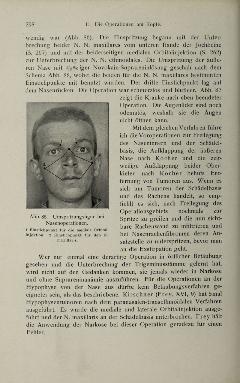 wendig war (Abb. 86). Die Einspritzung begann mit der Unter¬ brechung beider N. N. maxillares vom unteren Rande der Jochbeine (S. 267) und mit der beiderseitigen medialen Orbitalinjektion (S. 262) zur Unterbrechung der N. N. ethmoidales. Die Umspritzung der äuße¬ ren Nase mit i/^/oiger Novokain-Suprareninlösung geschah nach dem Schema Abb. 88, wobei die beiden für die N. N. maxillares bestimmten Einstichpunkte mit benutzt wurden. Der dritte Einstichpunkt lag auf dem Nasenrücken. Die Operation war schmerzlos und blutleer. Abb. 87 zeigt die Kranke nach eben beendeter Operation. Die Augenlider sind noch ödematös, weshalb sie die Augen nicht öffnen kann. Mit dem gleichen Verfahren führe ich die Voroperationen zur Freilegung des Naseninnern und der Schädel¬ basis, die Aufklappung der äußeren Nase nach Kocher und die zeit¬ weilige Aufklappung beider Ober¬ kiefer nach Kocher behufs Ent¬ fernung von Tumoren aus. Wenn es sich um Tumoren der Schädelbasis und des Rachens handelt, so emp¬ fiehlt es sich, nach Freilegung des Operationsgebiets nochmals zur Spritze zu greifen und die nun sicht¬ bare Rachenwand zu infiltrieren und bei Nasenrachenfibromen deren An¬ satzstelle zu unterspritzen, bevor man an die Exstirpation geht. Wer nur einmal eine derartige Operation in örtlicher Betäubung gesehen und die Unterbrechung der Trigeminusstämme gelernt hat, wird nicht auf den Gedanken kommen, sie jemals wieder in Narkose und ohne Suprareninanämie auszuführen. Für die Operationen an der Hypophyse von der Nase aus dürfte kein Betäubungsverfahren ge¬ eigneter sein, als das beschriebene. Kirschner (Frey, XVI, 9) hat 5mal Hypophysentumoren nach dem paranasalen-transethmoidalen Verfahren ausgeführt. Es wurde die mediale und laterale Orbitalinjektion ausge¬ führt und der N. maxillaris an der Schädelbasis unterbrochen. Frey hält die Anwendung der Narkose bei dieser Operation geradezu für einen Fehler. Abb. 88. Umspritzungsfigur bei Nasenoperationen. 1 Einstichpunkt für die mediale Orbital¬ injektion. 2 Einsticlipunkt für den N. maxillaris.