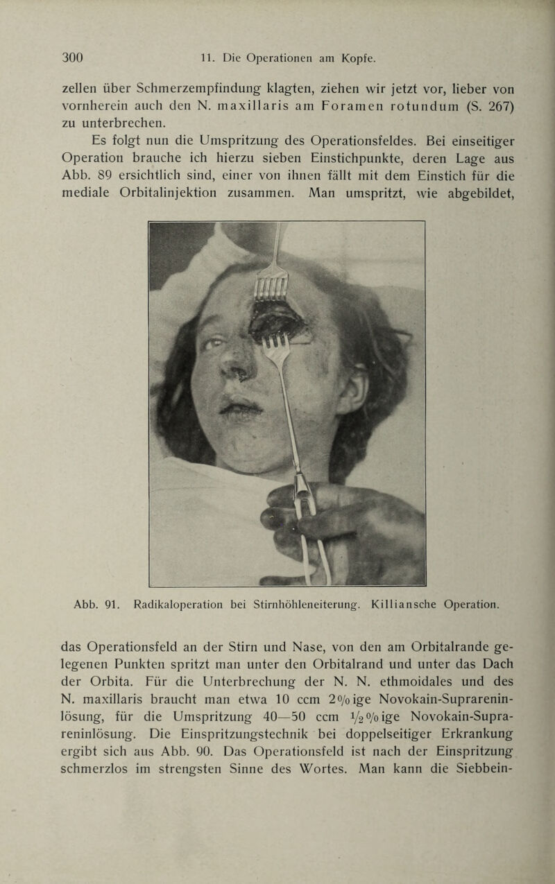 zellen über Schmerzempfindung klagten, ziehen wir jetzt vor, lieber von vornherein auch den N. maxillaris am Foramen rotundum (S. 267) zu unterbrechen. Es folgt nun die Umspritzung des Operationsfeldes. Bei einseitiger Operation brauche ich hierzu sieben Einstichpunkte, deren Lage aus Abb. 89 ersichtlich sind, einer von ihnen fällt mit dem Einstich für die mediale Orbitalinjektion zusammen. Man umspritzt, wie abgebildet, Abb. 91. Radikaloperation bei Stirnhöhleneiterung. Killiansche Operation. das Operationsfeld an der Stirn und Nase, von den am Orbitalrande ge¬ legenen Punkten spritzt man unter den Orbitalrand und unter das Dach der Orbita. Für die Unterbrechung der N. N. ethmoidales und des N. maxillaris braucht man etwa 10 ccm 2o/0ige Novokain-Suprarenin- lösung, für die Umspritzung 40—50 ccm V2%ige Novokain-Supra- reninlösung. Die Einspritzungstechnik bei doppelseitiger Erkrankung ergibt sich aus Abb. 90. Das Operationsfeld ist nach der Einspritzung schmerzlos im strengsten Sinne des Wortes. Man kann die Siebbein-